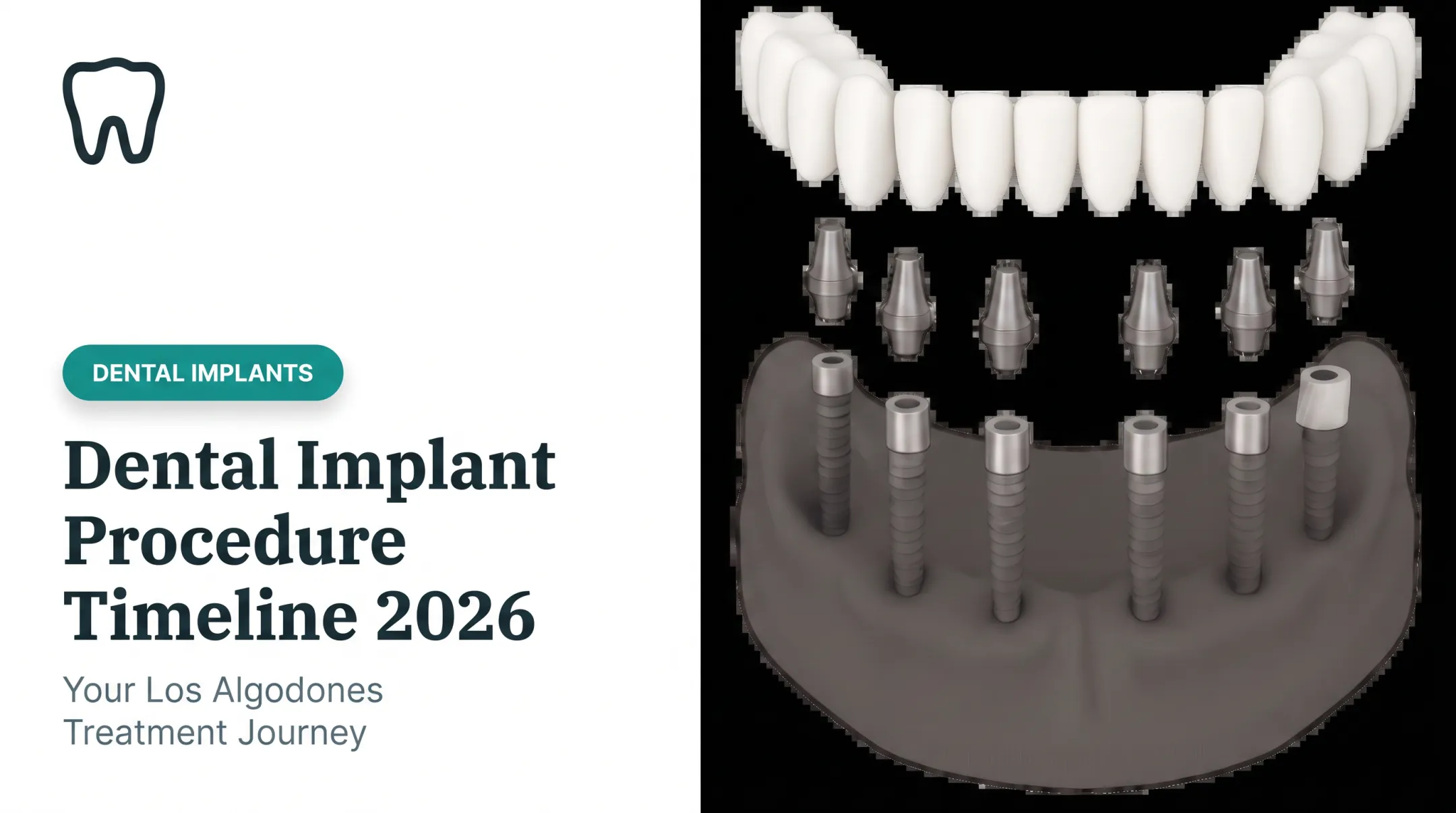 Dental Implant Procedure Timeline 2026