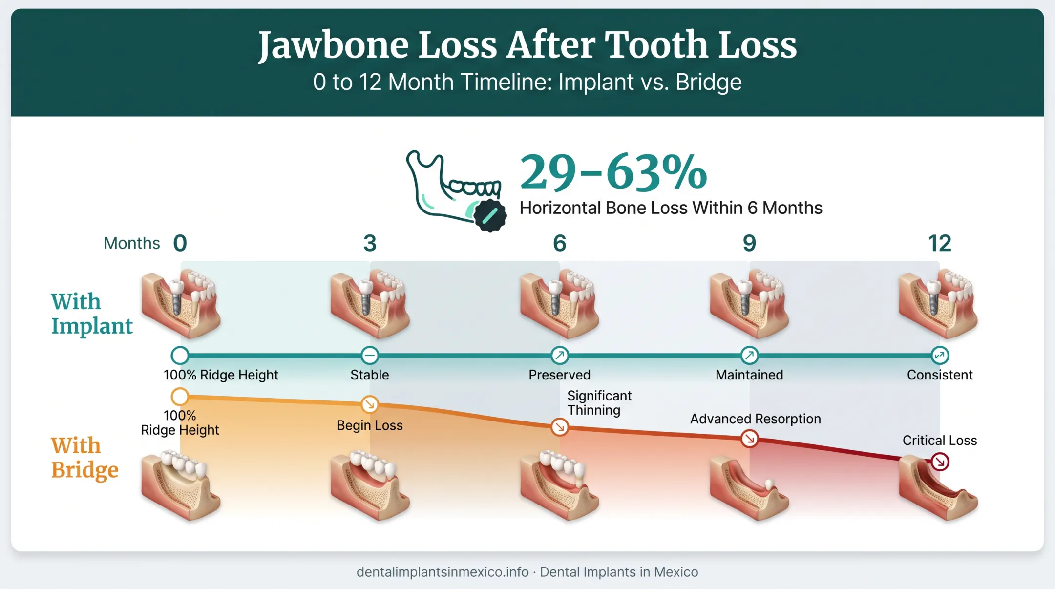 Jawbone density loss timeline comparing implants versus bridges over time