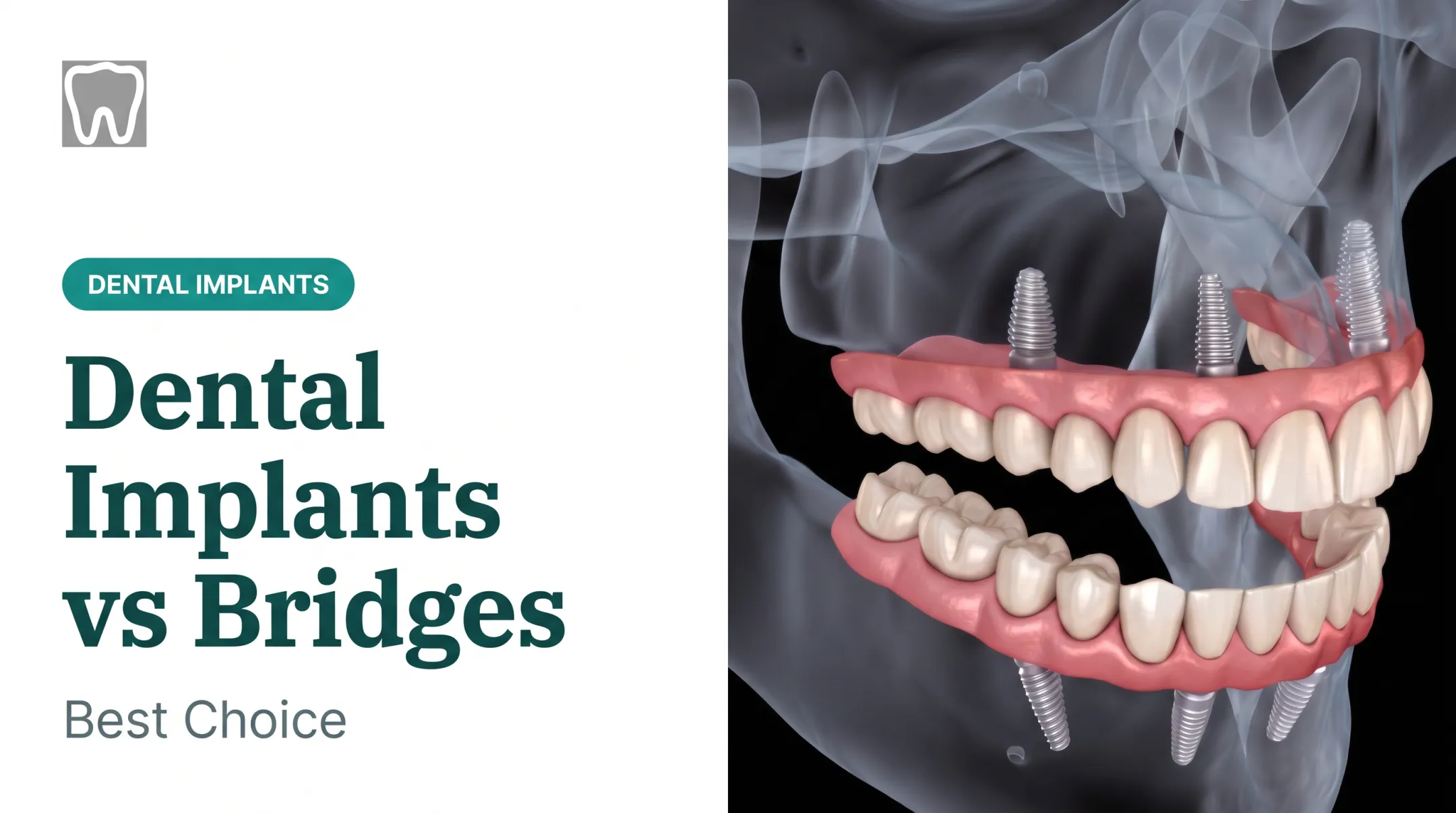 Dental Implants vs Bridges: Best Choice