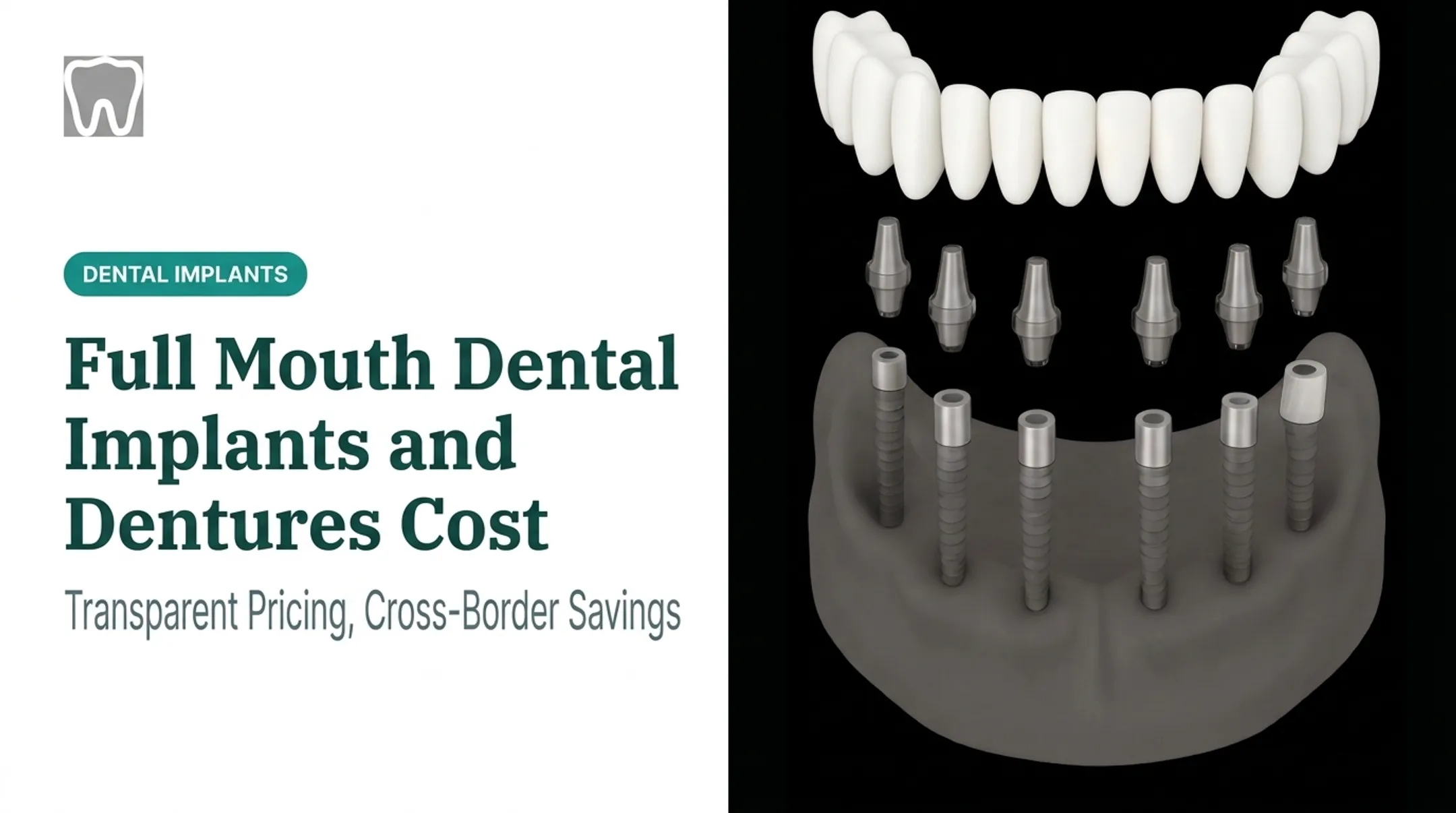 Full Mouth Dental Implants and Dentures Cost