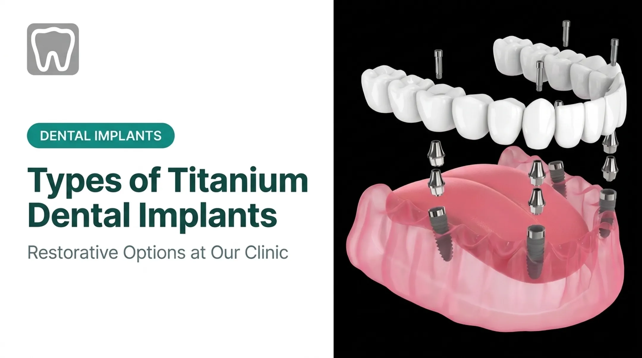 Types of Titanium Dental Implants