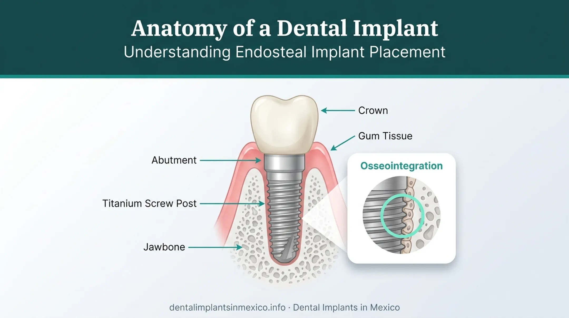Endosteal titanium implant cross-section showing post abutment and crown placement