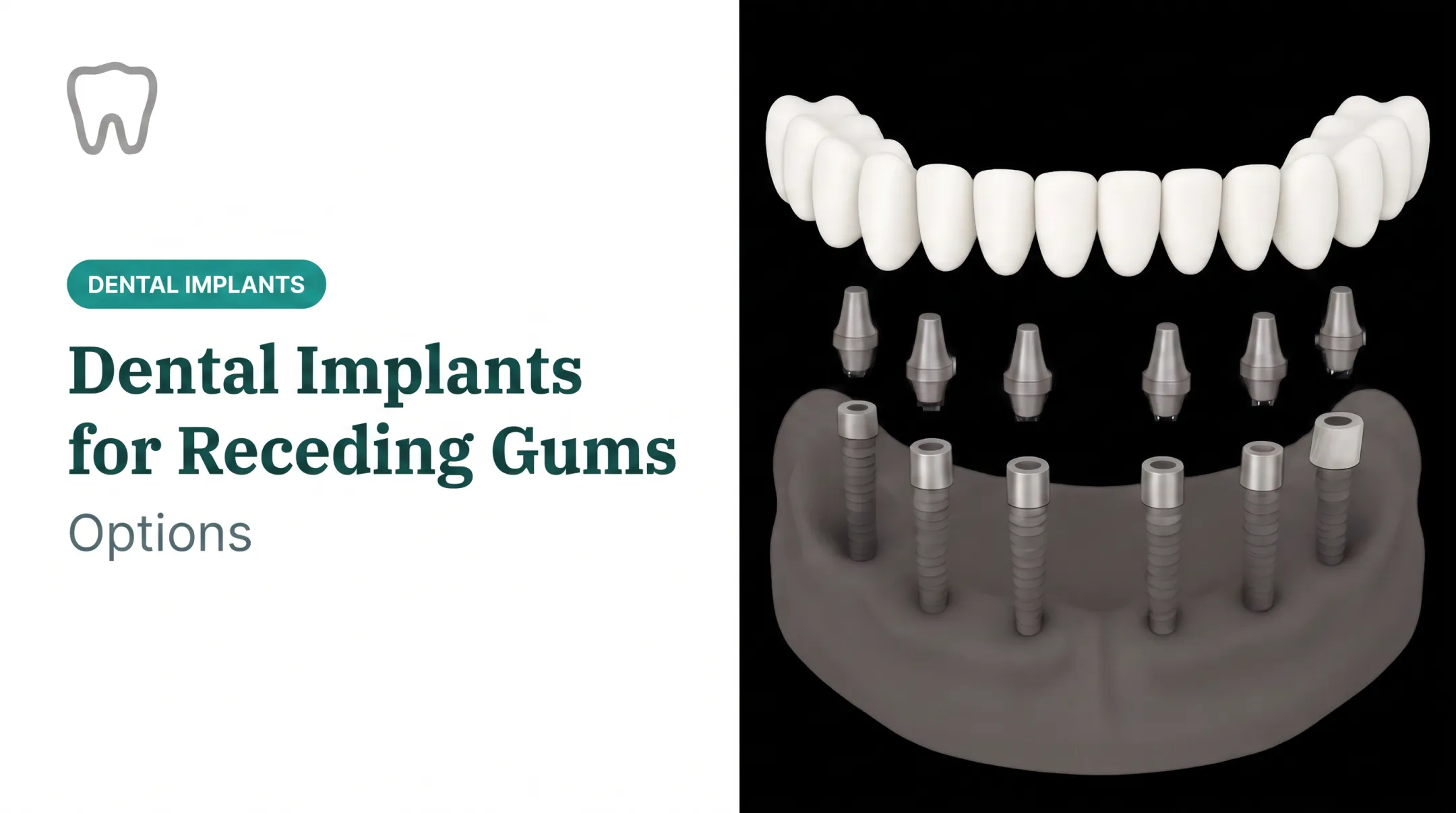 Dental Implants for Receding Gums: Options