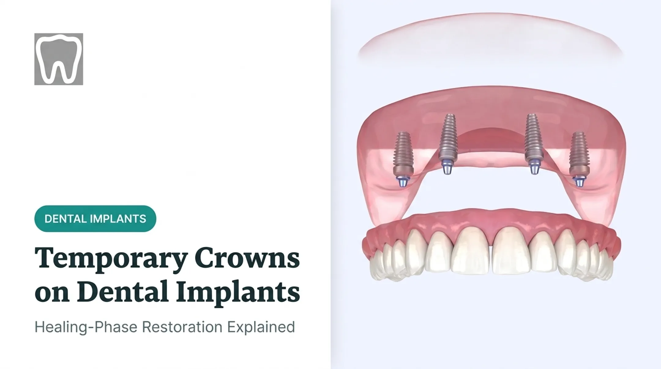 Temporary Crowns on Dental Implants
