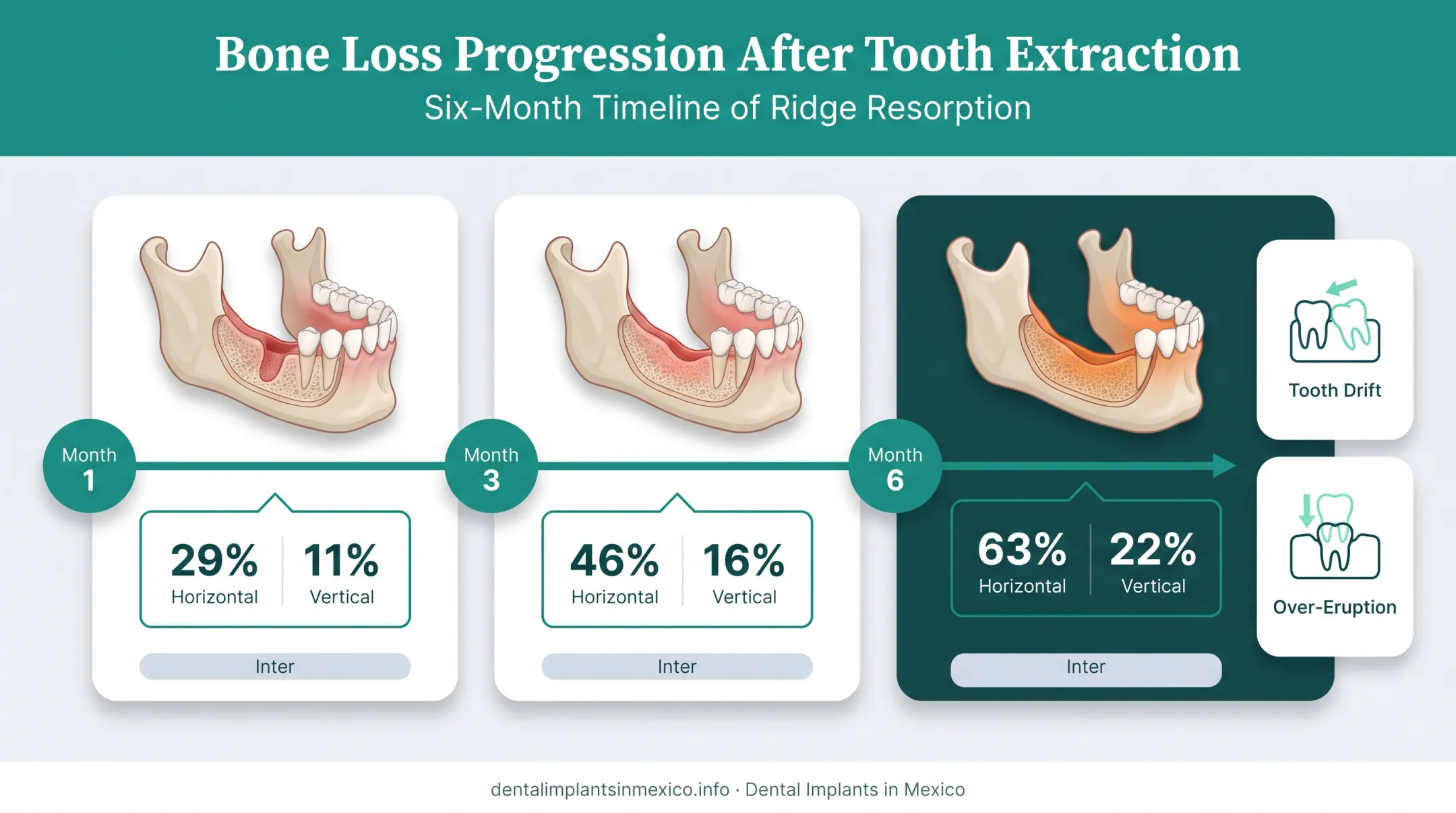 Timeline of jawbone loss stages after missing molar extraction