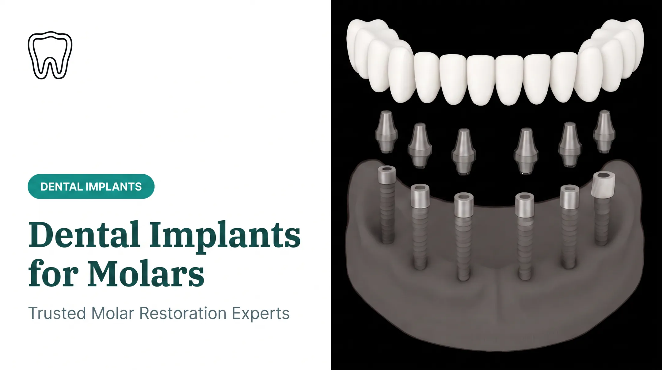Dental Implants for Molars