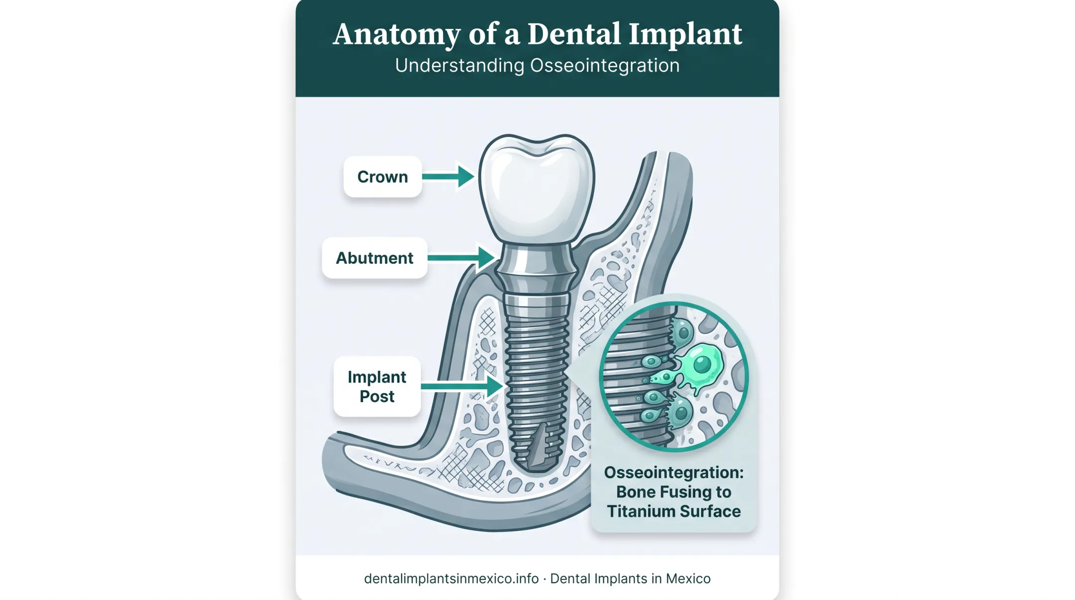 Titanium dental implant anatomy showing post abutment and crown