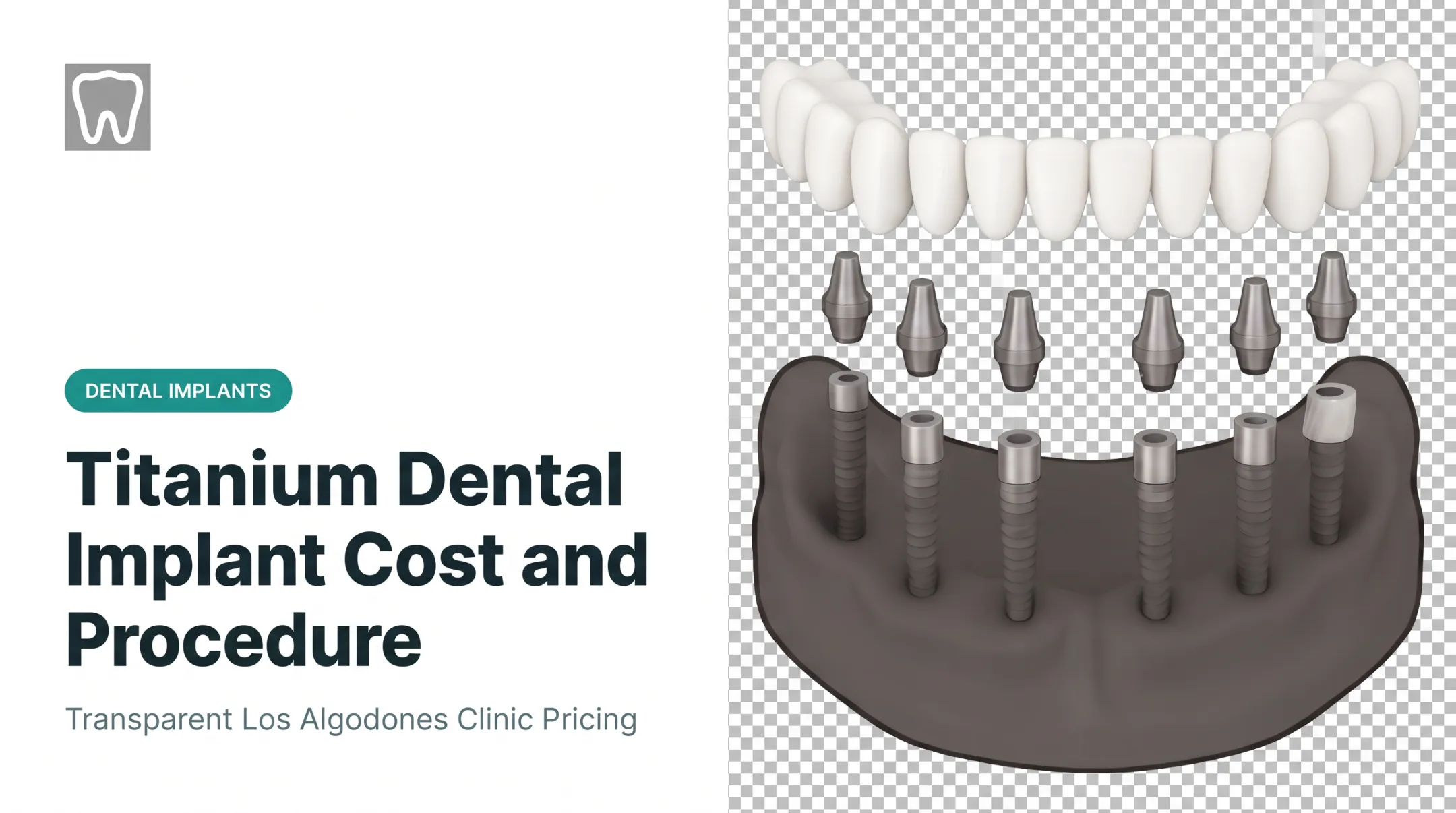 Titanium Dental Implant Cost and Procedure