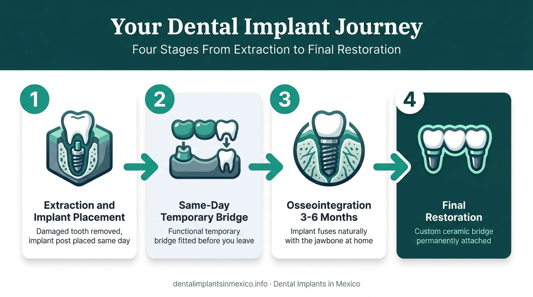 Four-step All-on-4 dental implant procedure timeline from extraction to final bridge
