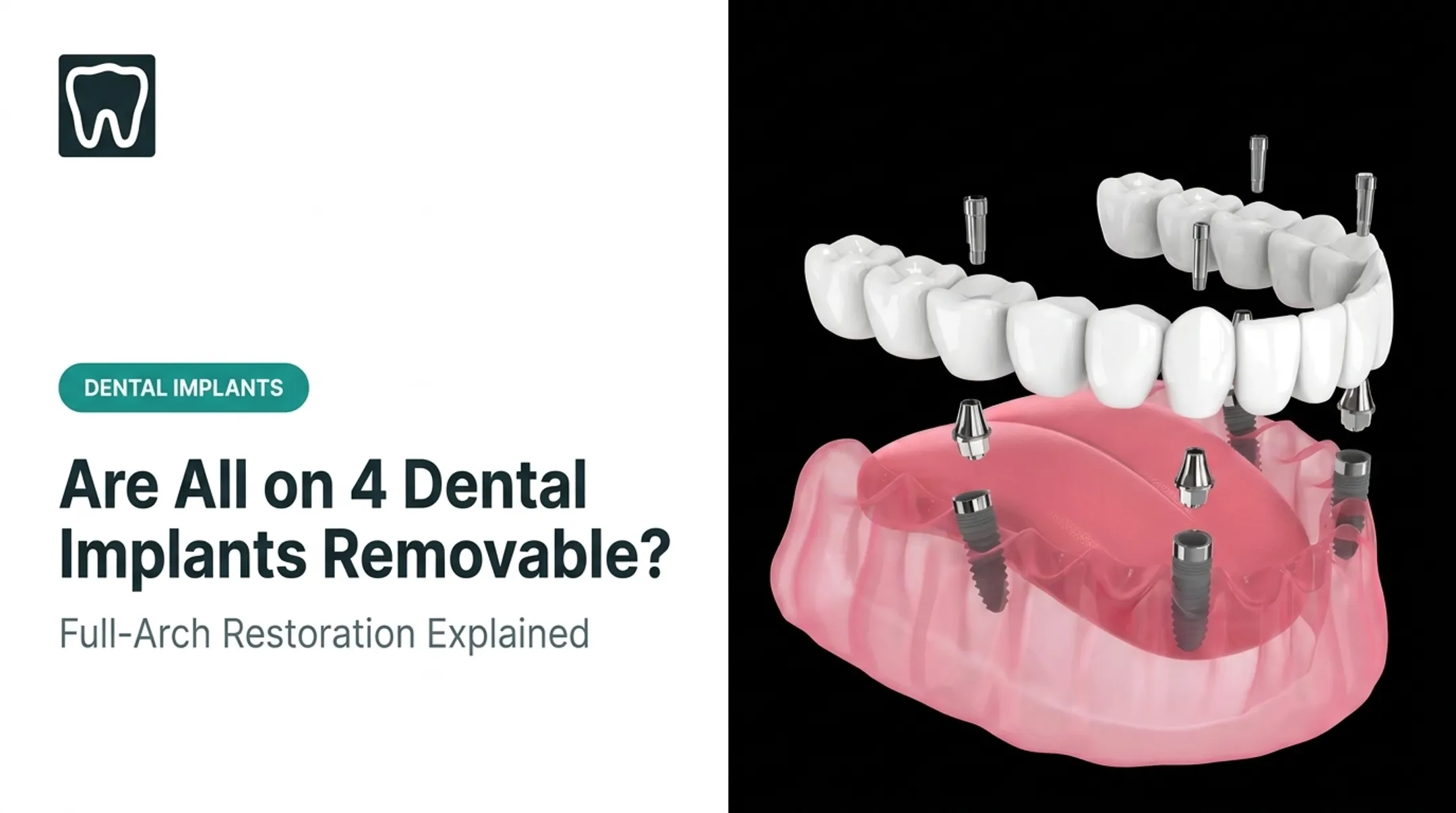 Are All on 4 Dental Implants Removable?