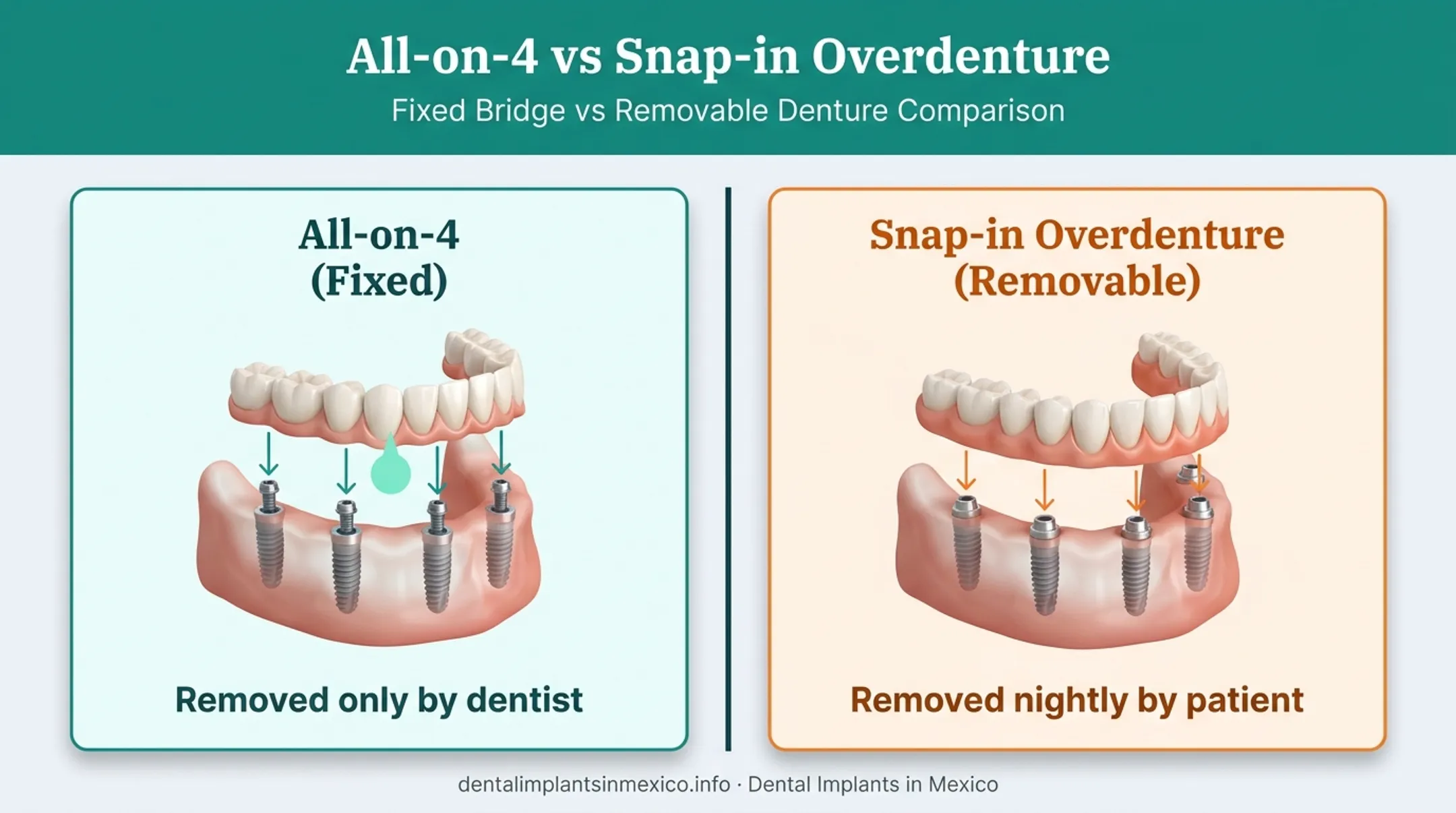 Fixed All-on-4 bridge versus removable snap-in denture comparison diagram