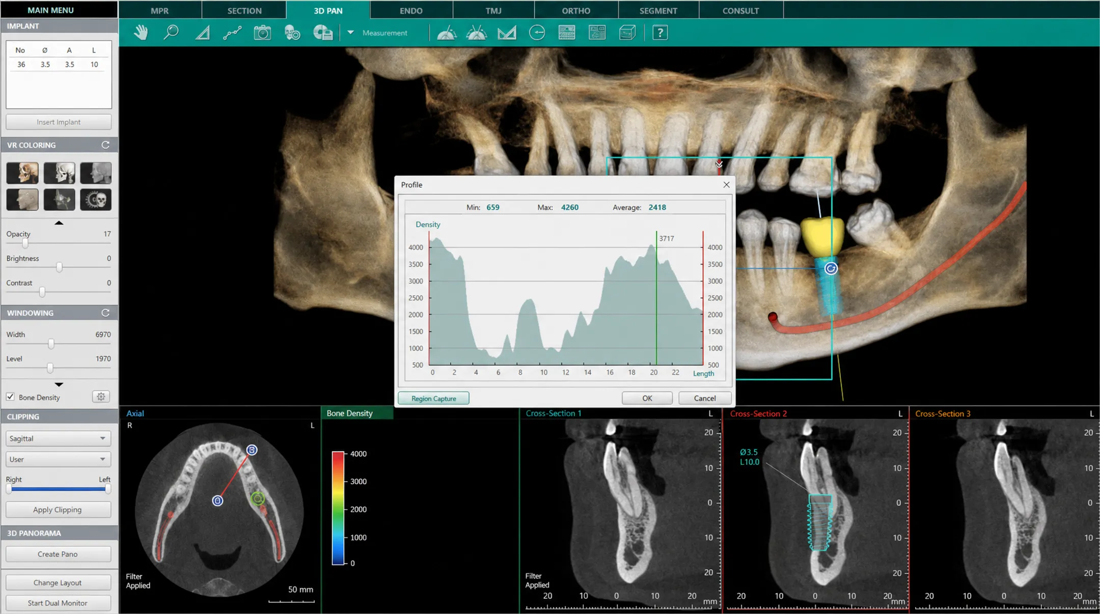 3D CBCT dental scan showing jawbone density for implant planning