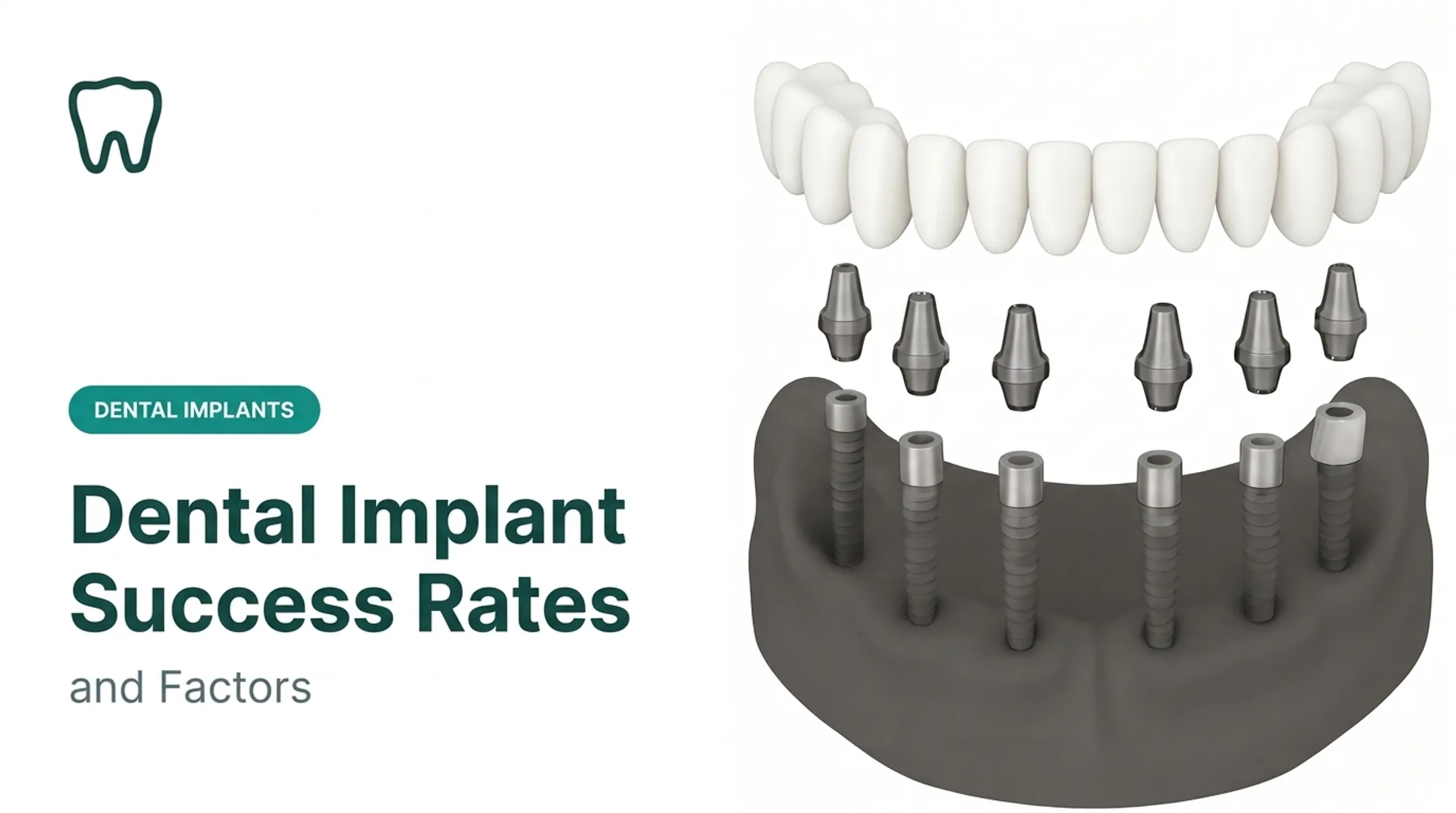 Dental Implant Success Rates and Factors