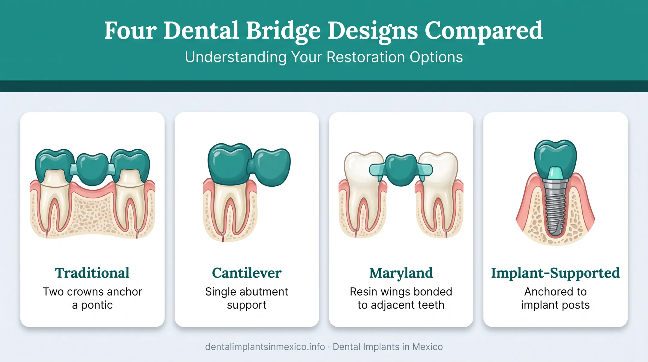 Four types of dental bridges compared side by side diagram