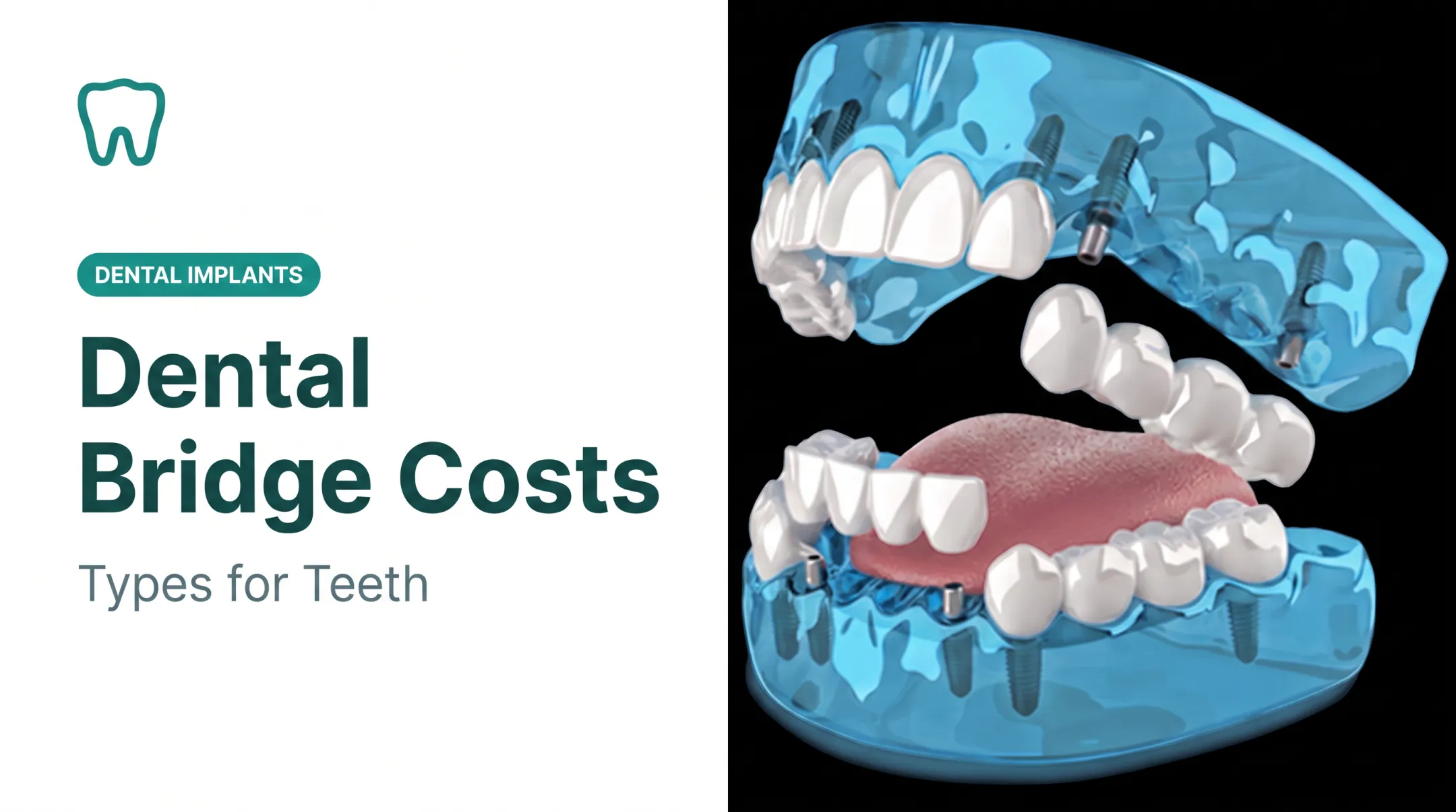 Dental Bridge Costs: Types for Teeth