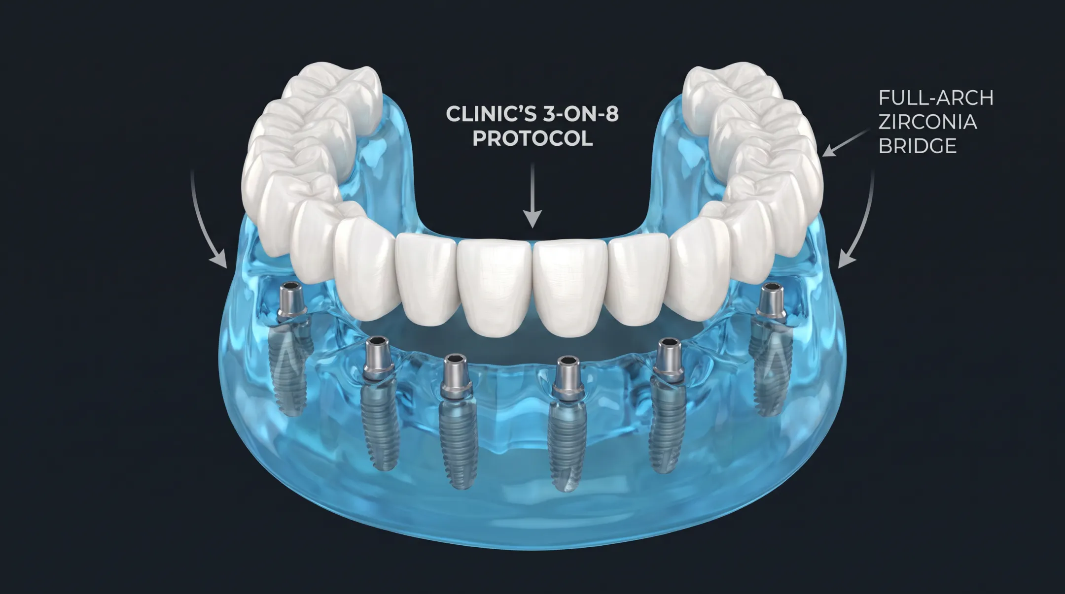 3-ON-8 full-mouth zirconia bridge implant protocol illustration