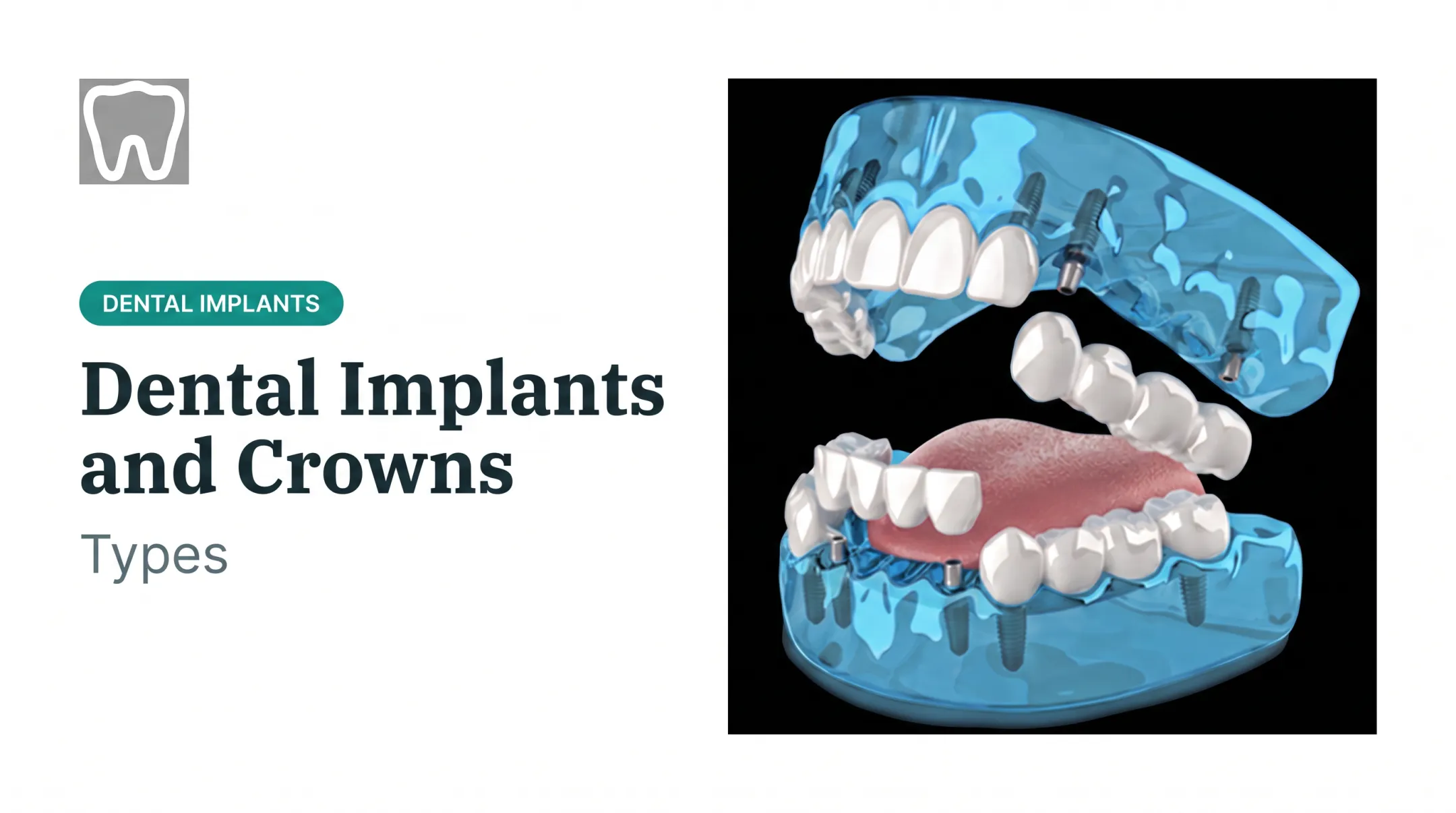 Dental Implants and Crowns: Types
