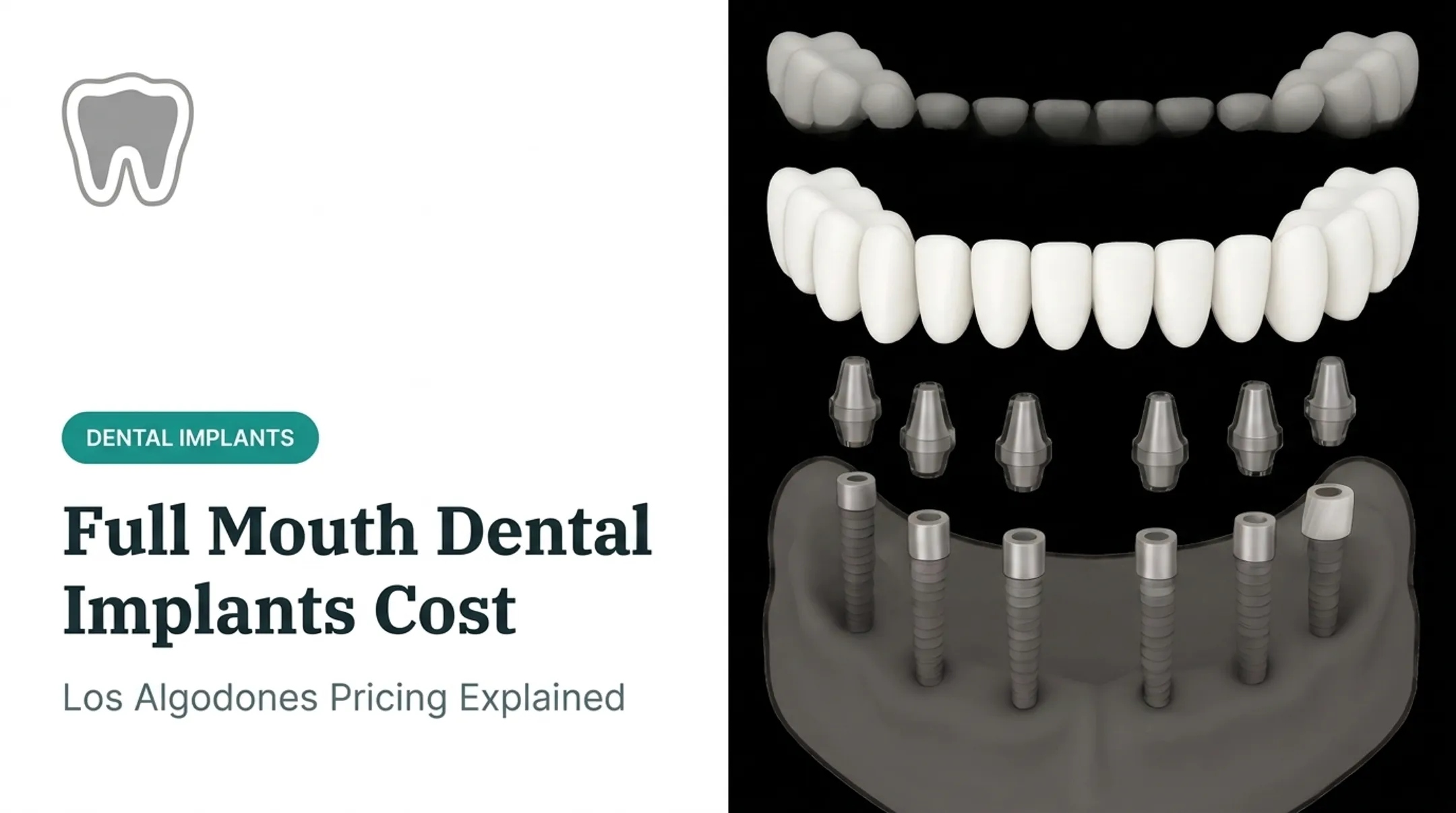 Full Mouth Dental Implants Cost