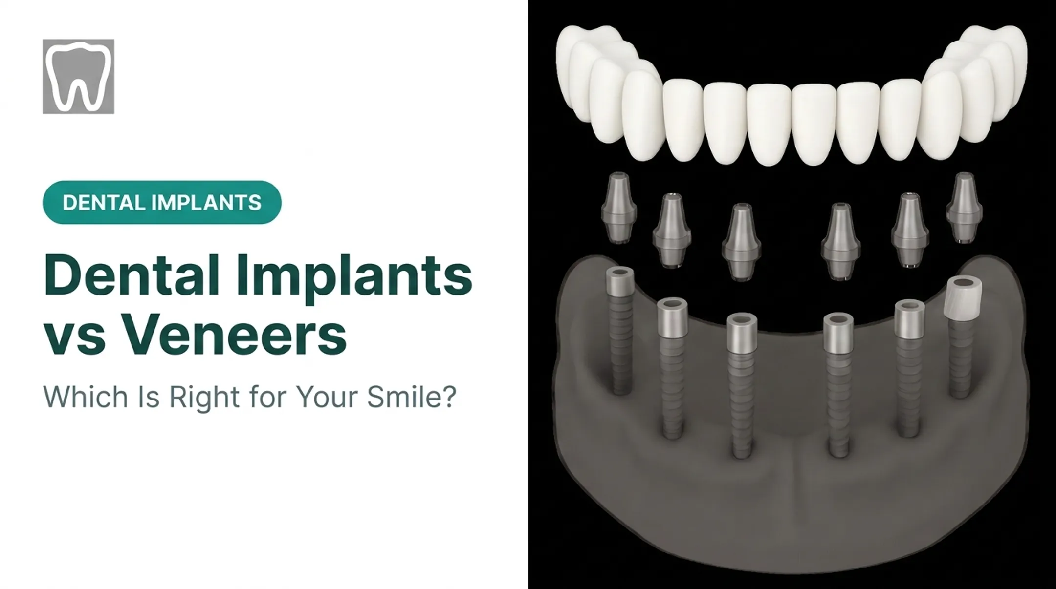 Dental Implants vs Veneers: Which Is Right for Your Smile?