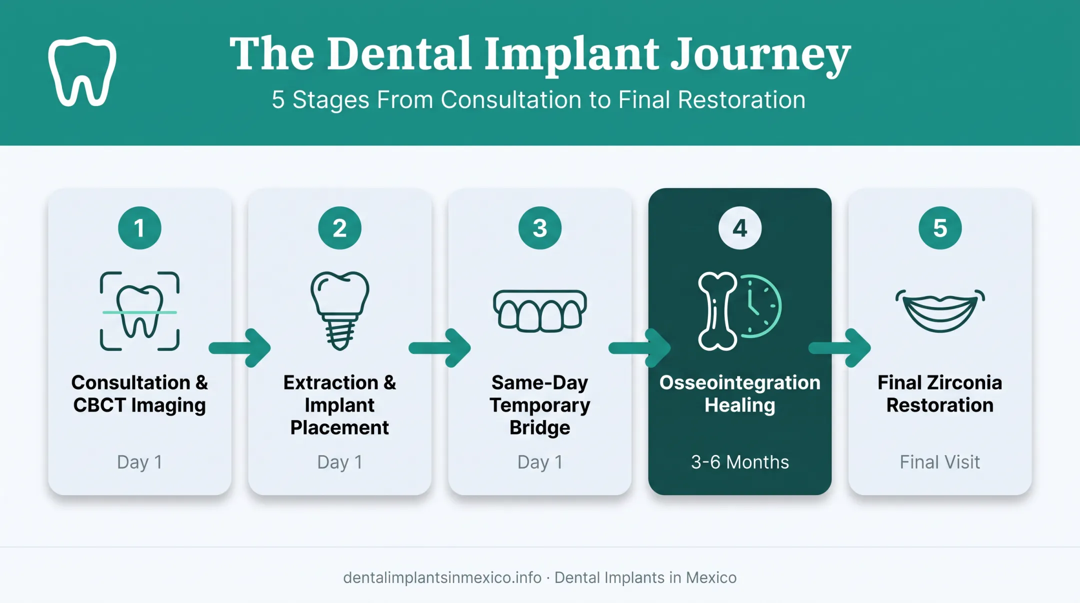 5-step All-on-4 dental implant procedure from consultation to final bridge
