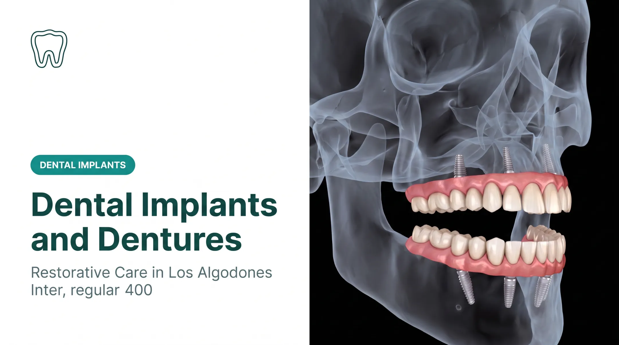 Dental Implants and Dentures