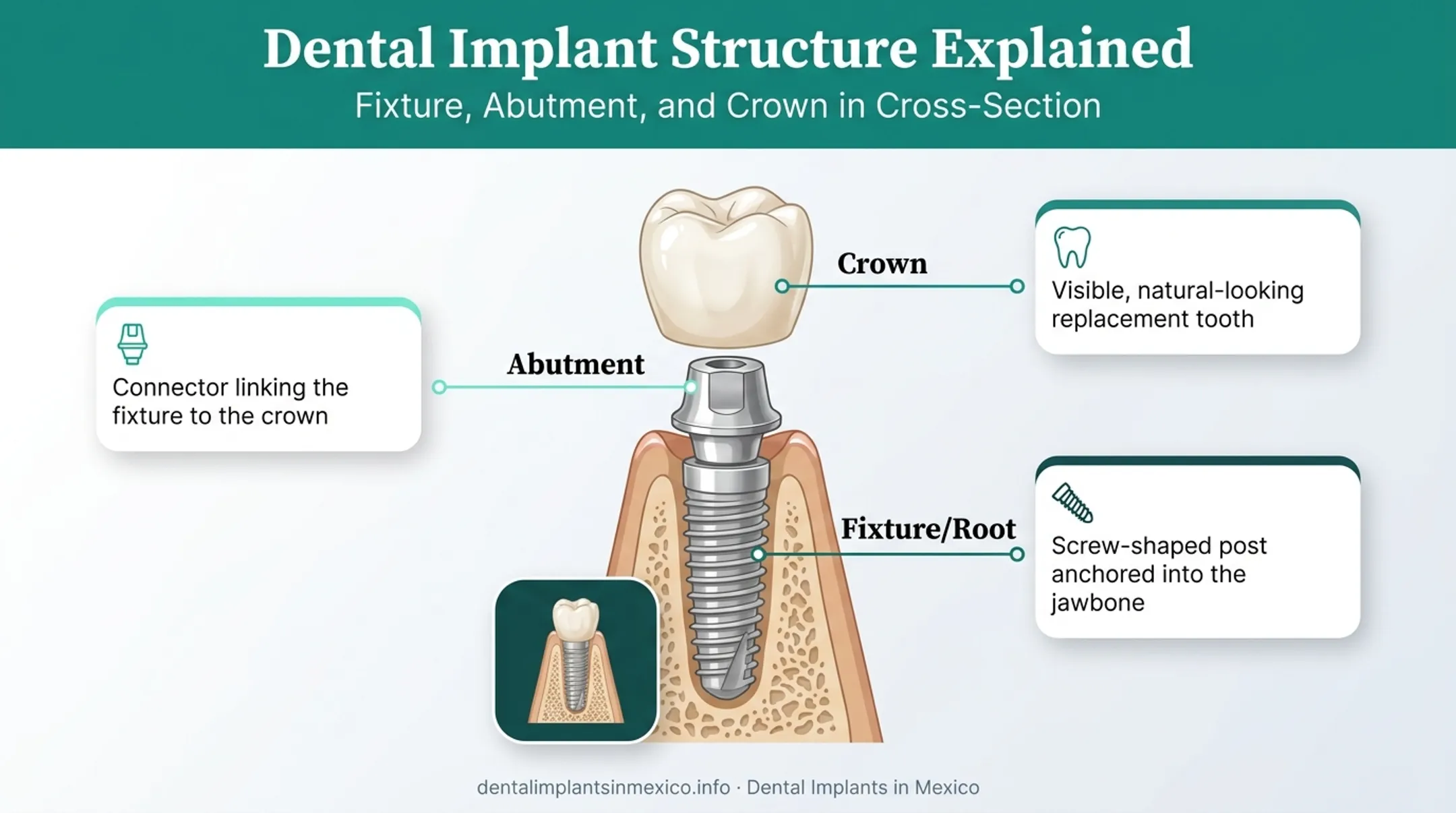 Three-part dental implant structure showing fixture abutment and crown