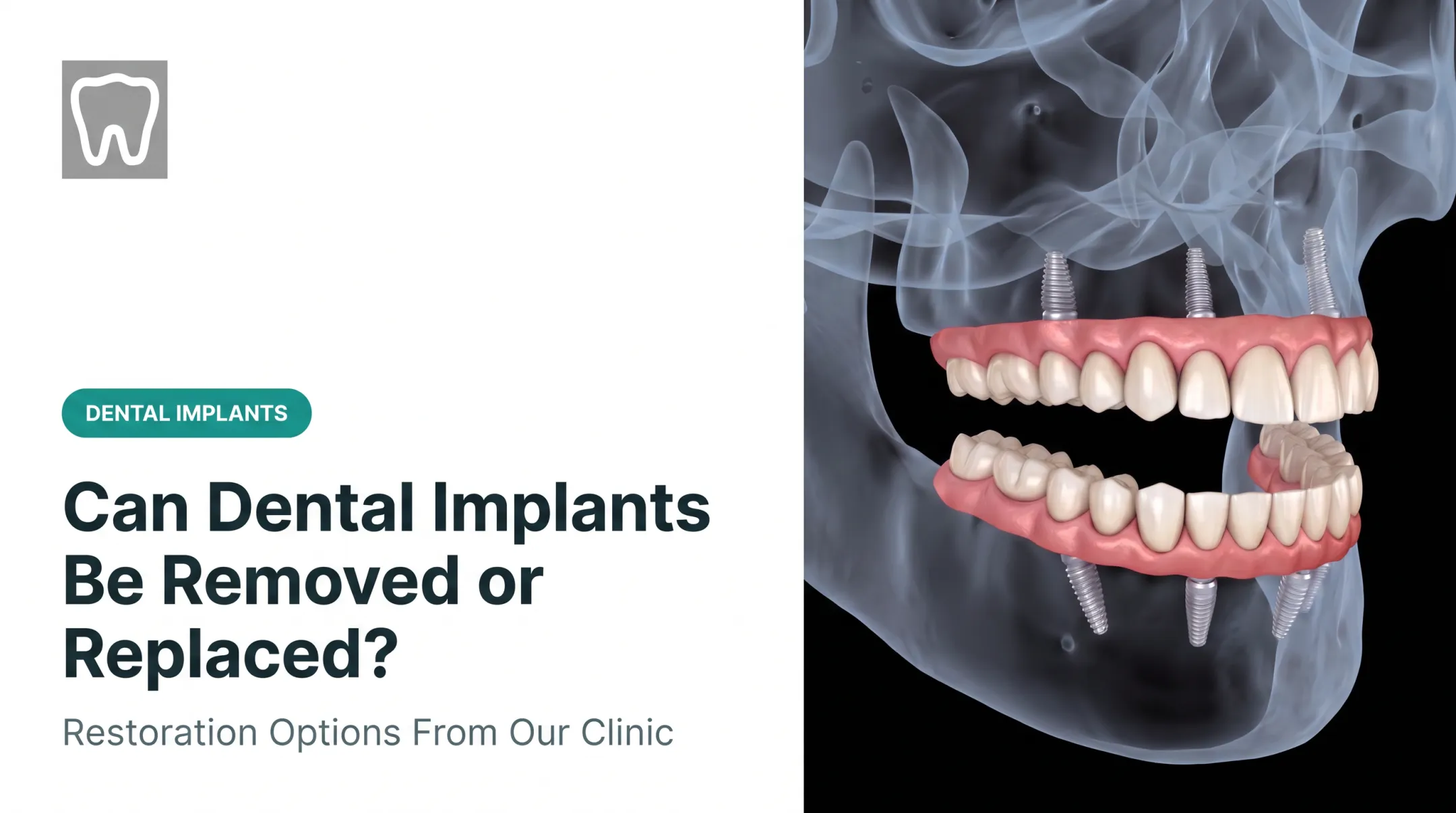 Can Dental Implants Be Removed or Replaced?