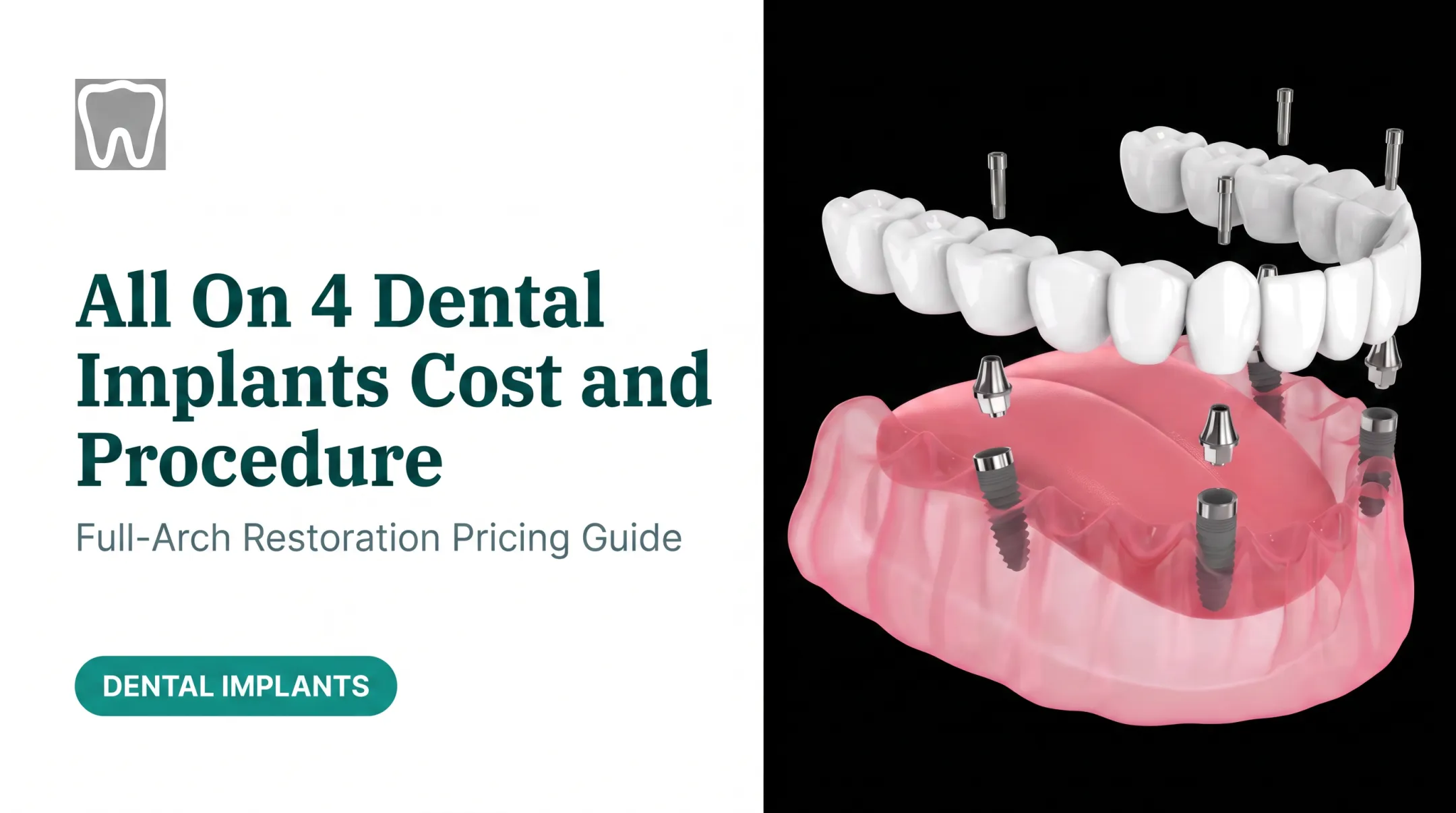 All On 4 Dental Implants Cost and Procedure