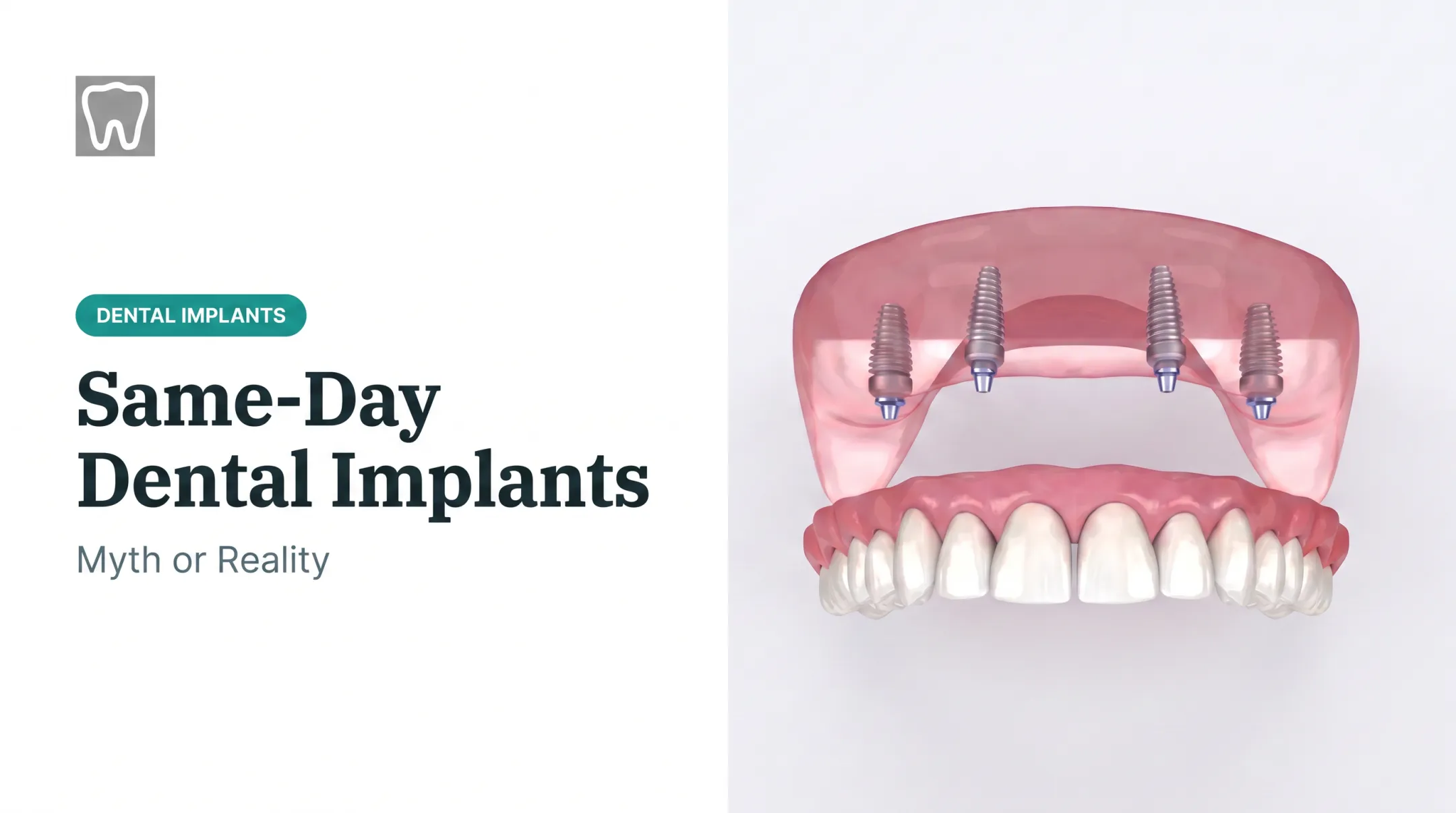 Same-Day Dental Implants: Myth or Reality