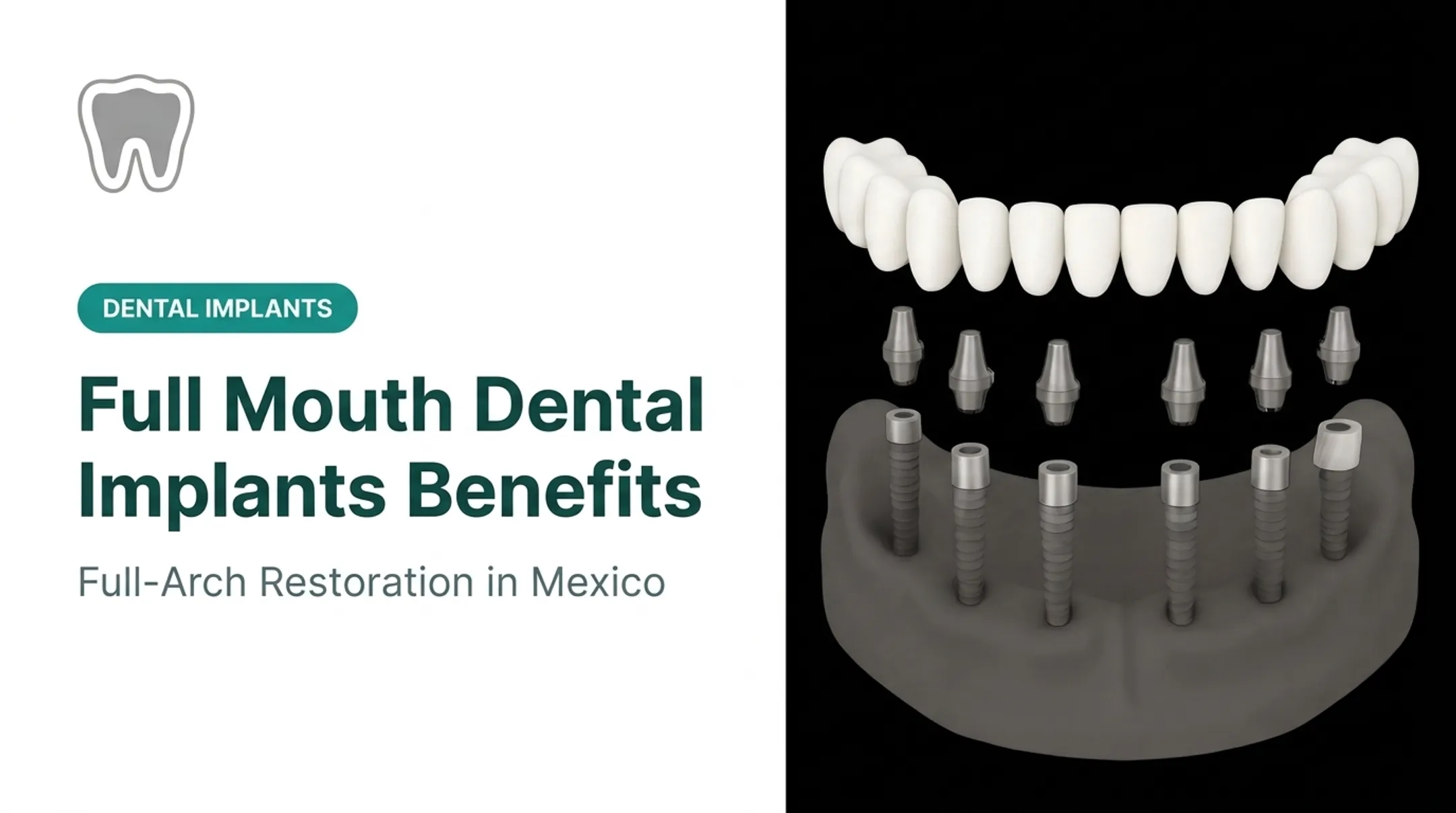 Full Mouth Dental Implants Benefits