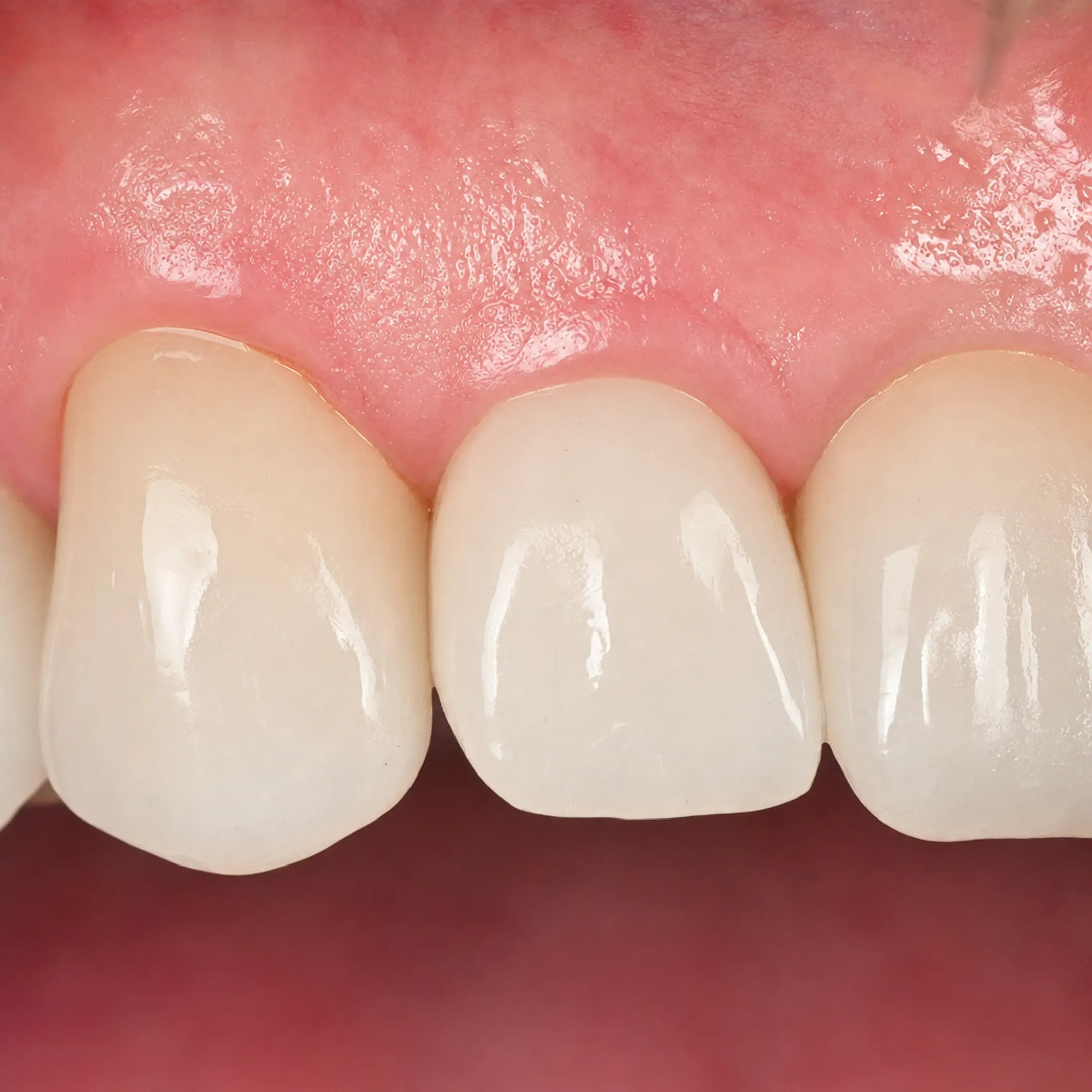 Natural-looking porcelain dental crown on front tooth implant