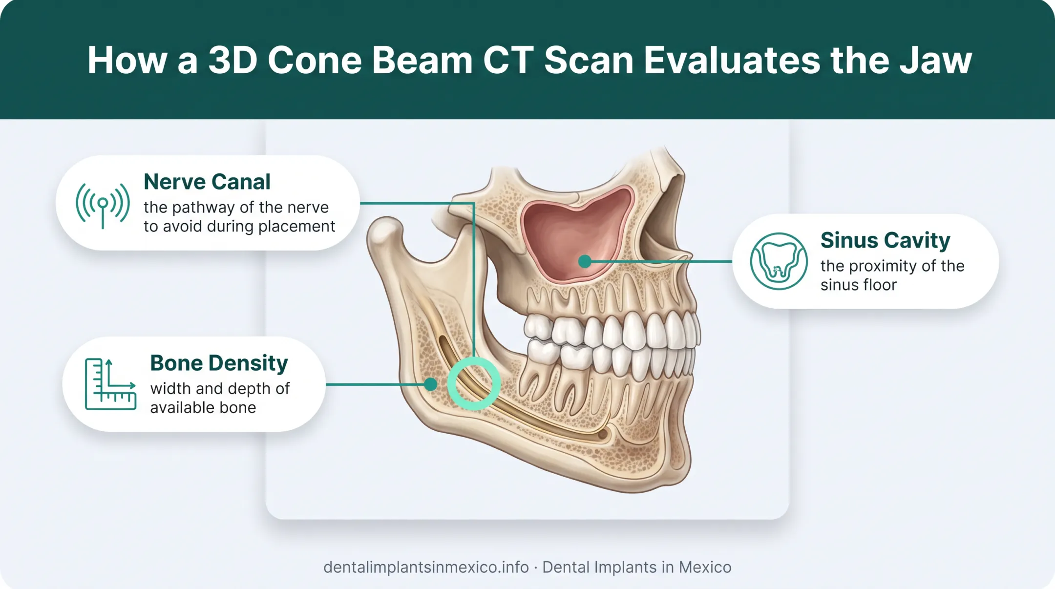 3D CBCT scan process showing bone density and nerve mapping