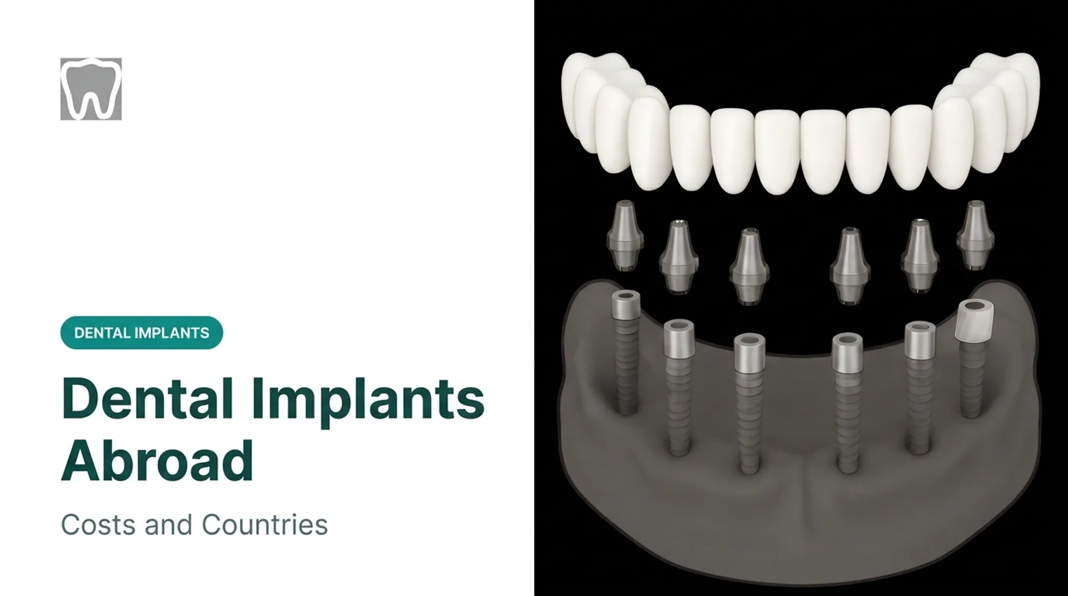 Dental Implants Abroad: Costs and Countries