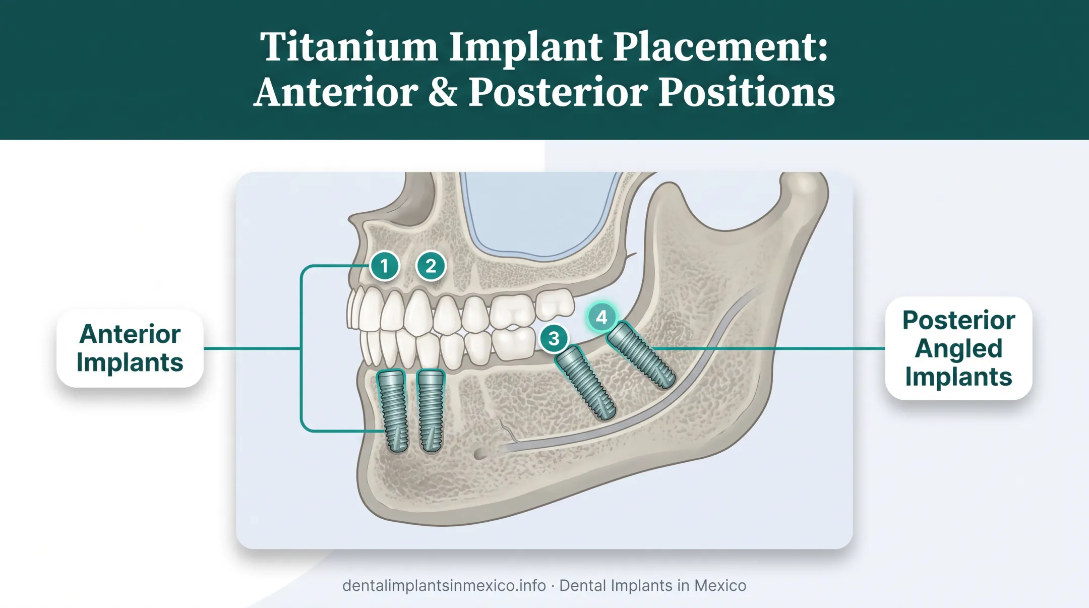 All-on-4 dental implant placement diagram showing angled posterior implants