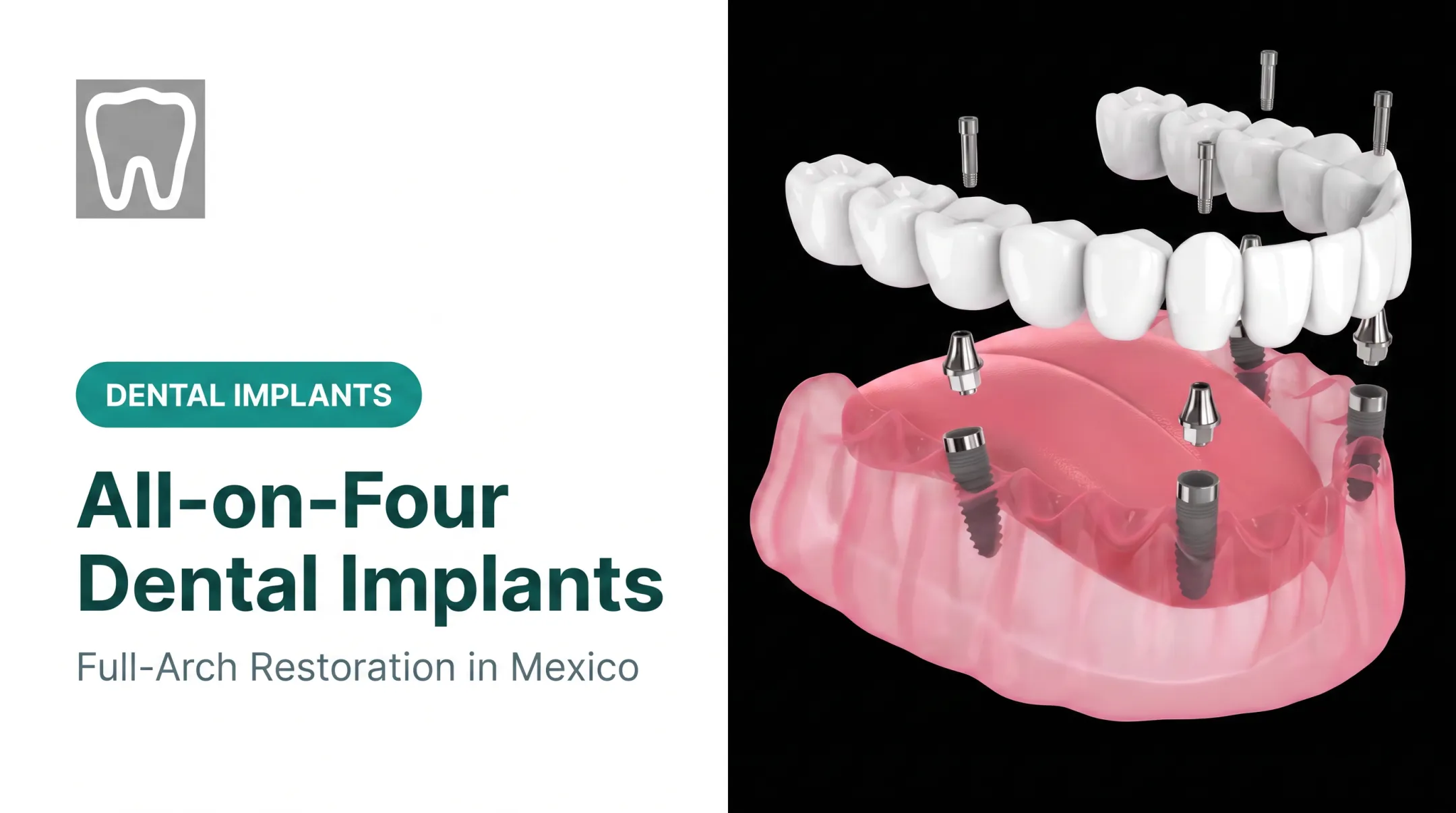 All-on-Four Dental Implants