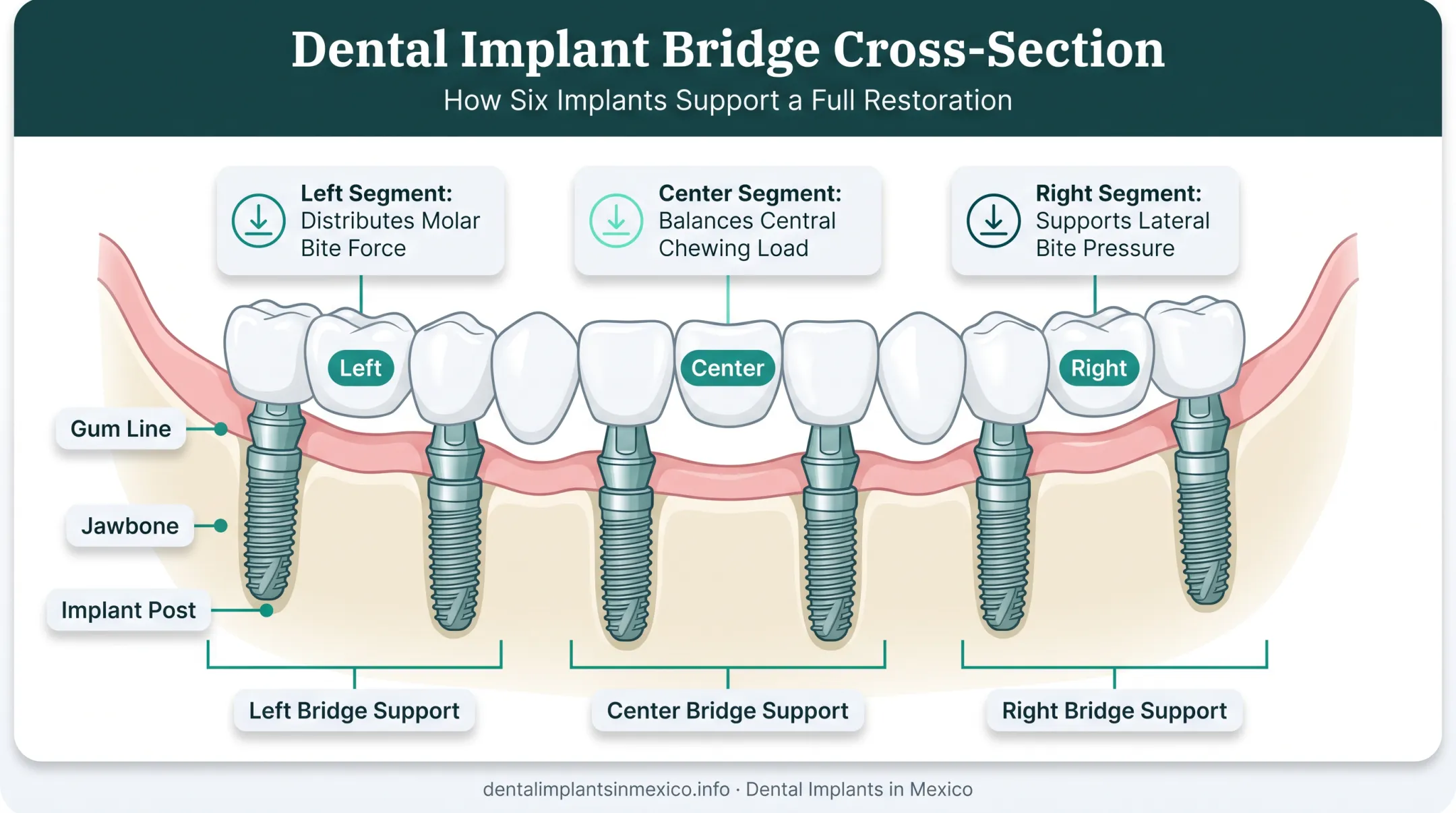 3 on 6 dental implant structure showing six implants and three bridges