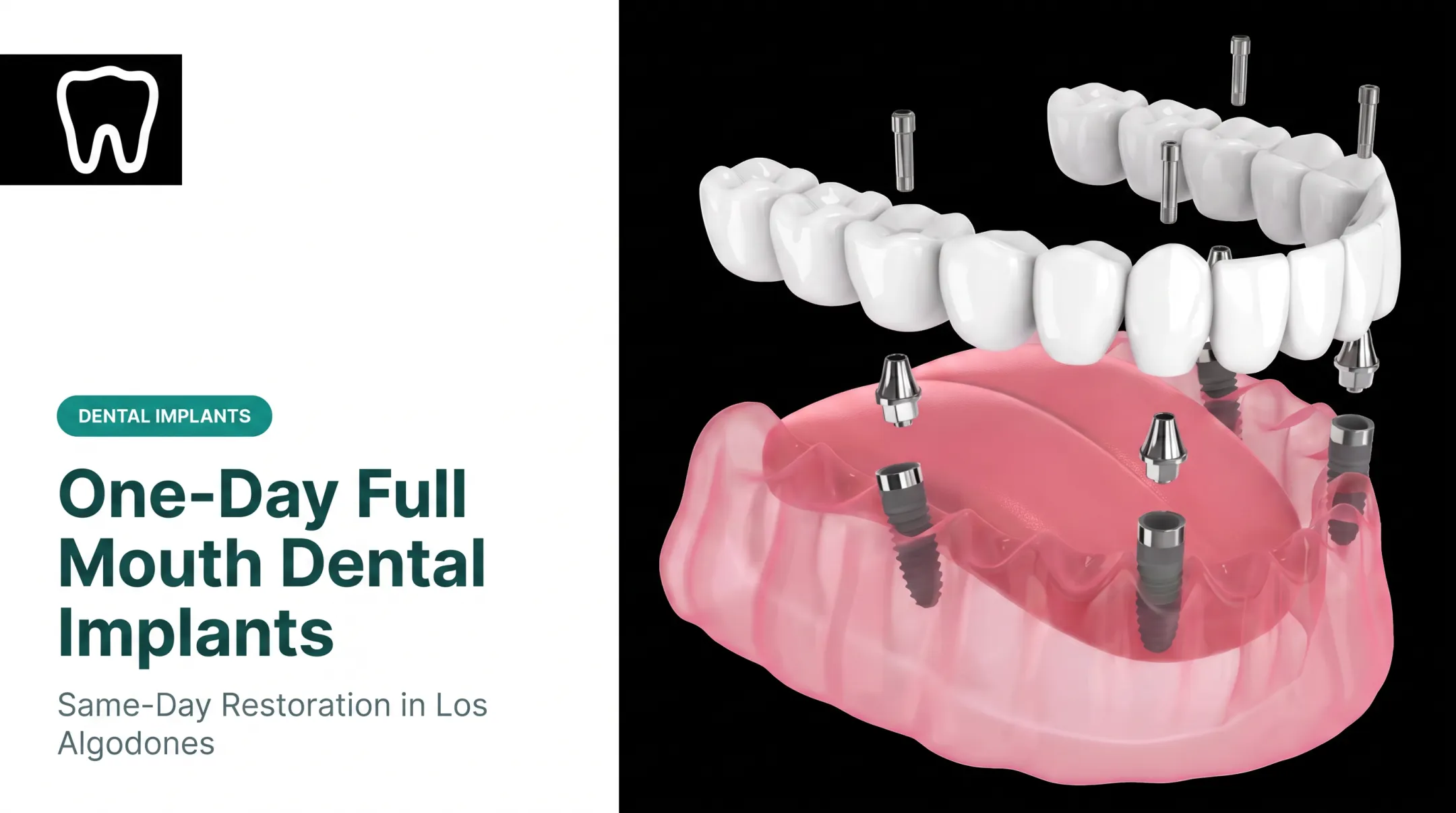 One-Day Full Mouth Dental Implants