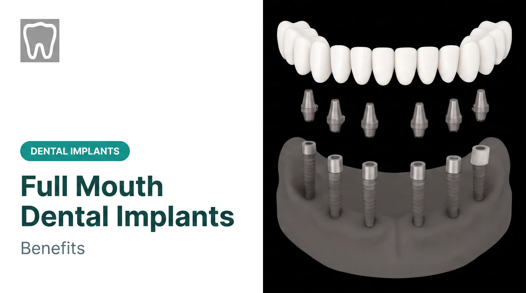 Full Mouth Dental Implants: Benefits