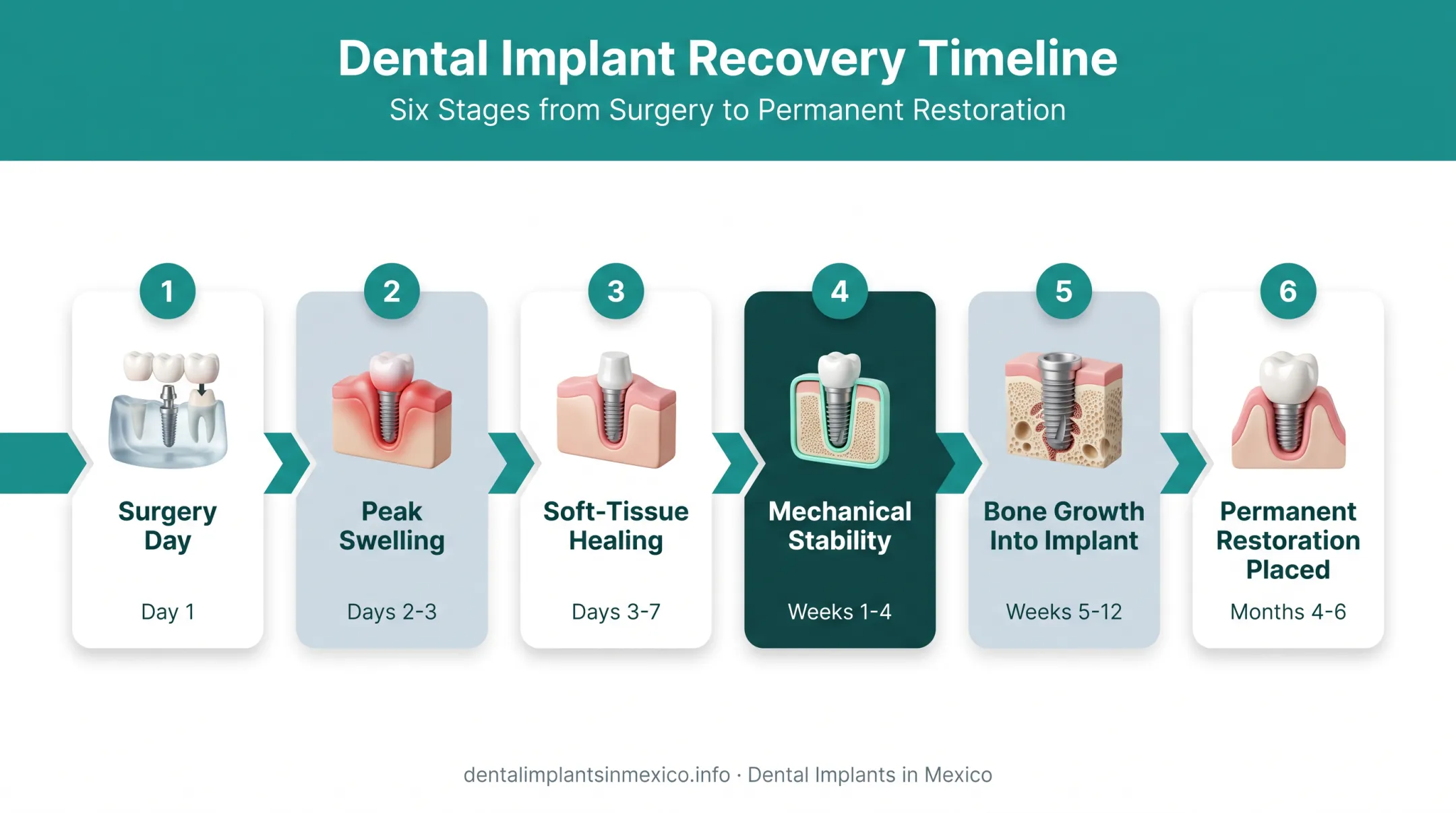 All-on-4 dental implant recovery timeline from surgery to permanent restoration