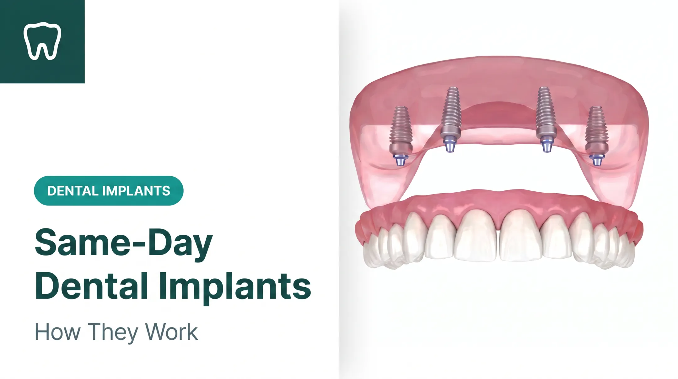 Same-Day Dental Implants: How They Work