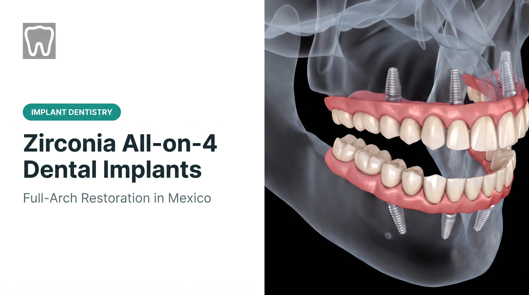 Zirconia All-on-4 Dental Implants