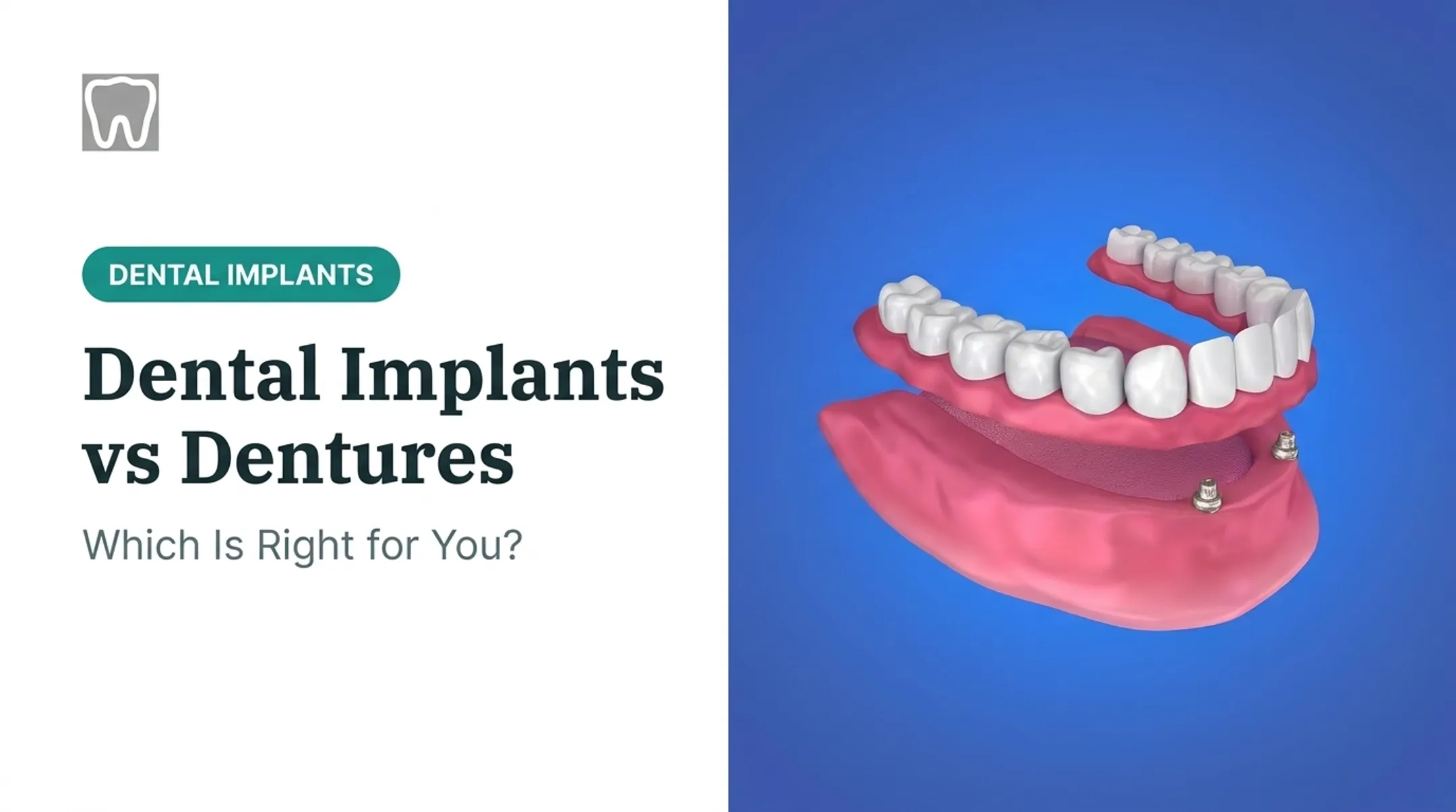 Dental Implants vs Dentures: Which Is Right for You?