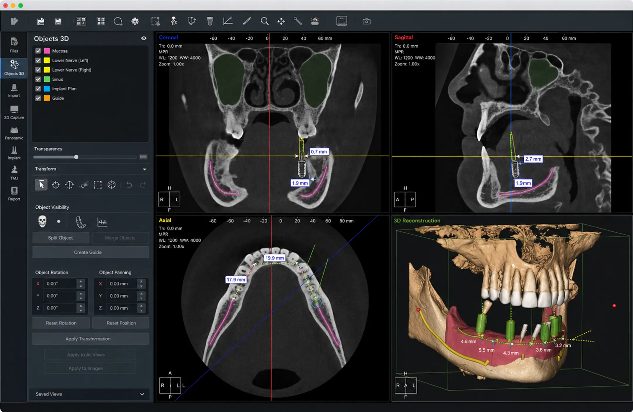 3D CBCT scan showing jawbone density and nerve pathway imaging
