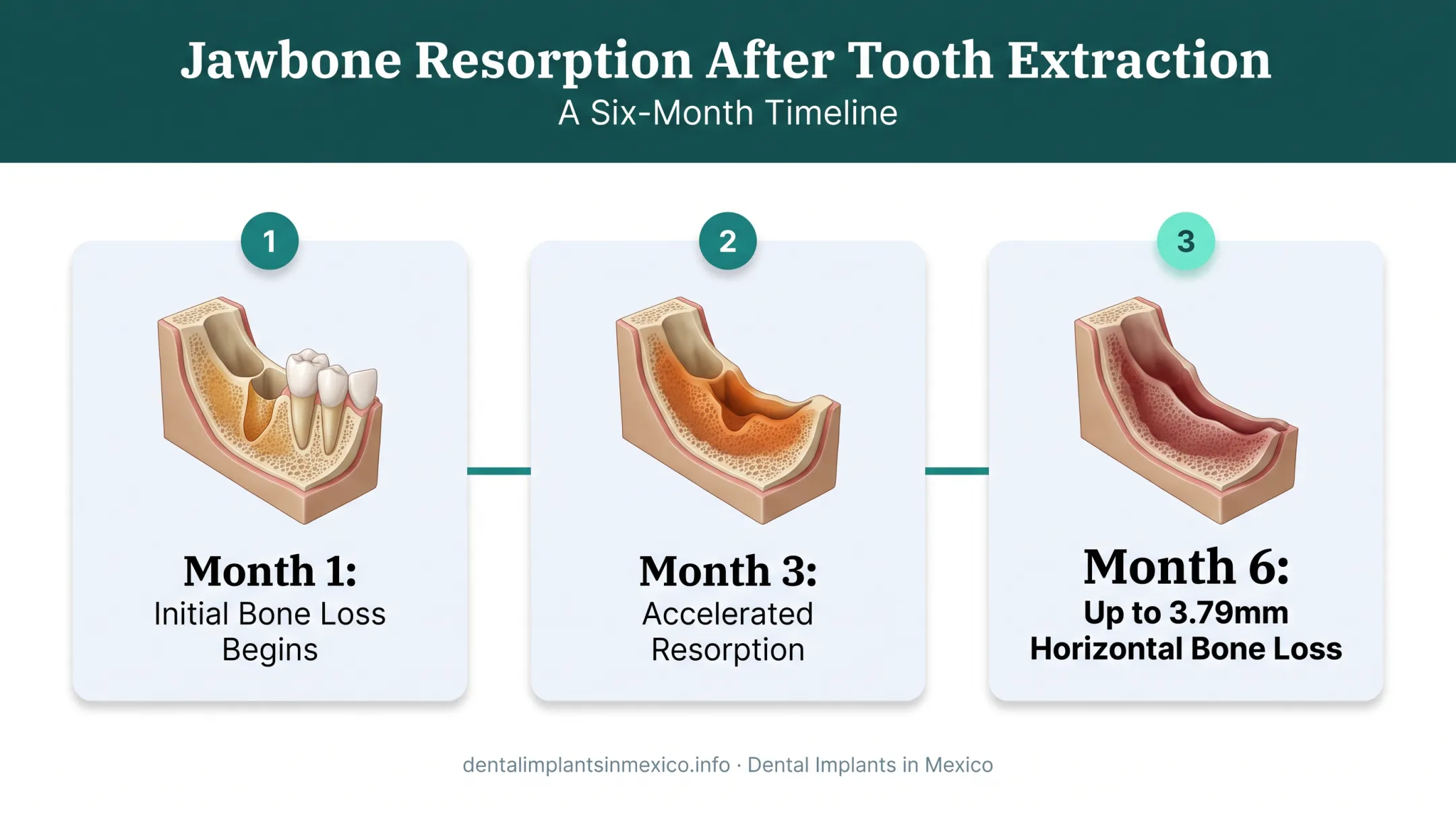 Jawbone resorption timeline after tooth extraction showing bone loss progression