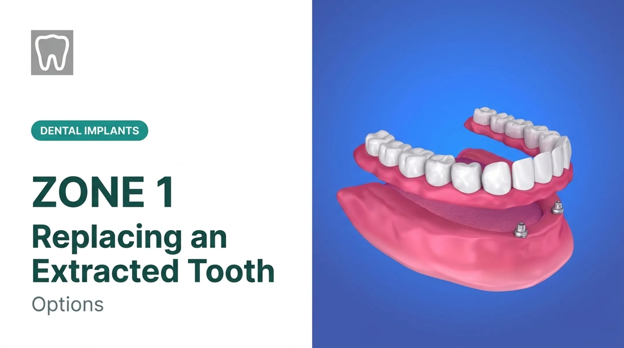 Replacing an Extracted Tooth: Options