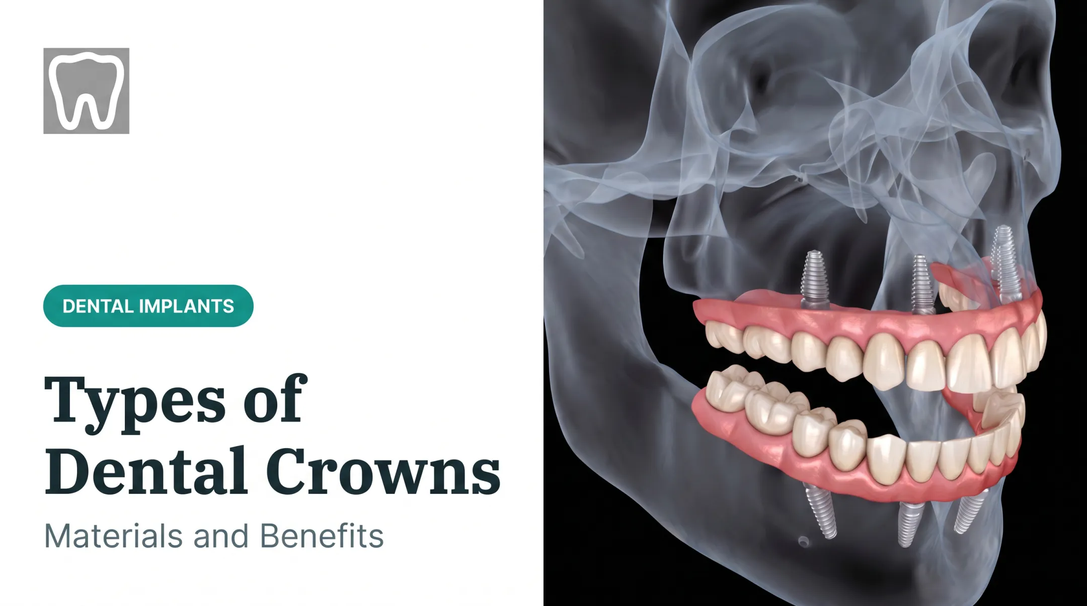Types of Dental Crowns: Materials and Benefits