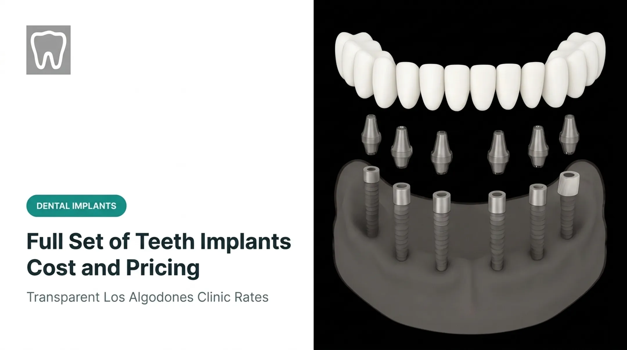 Full Set of Teeth Implants Cost and Pricing