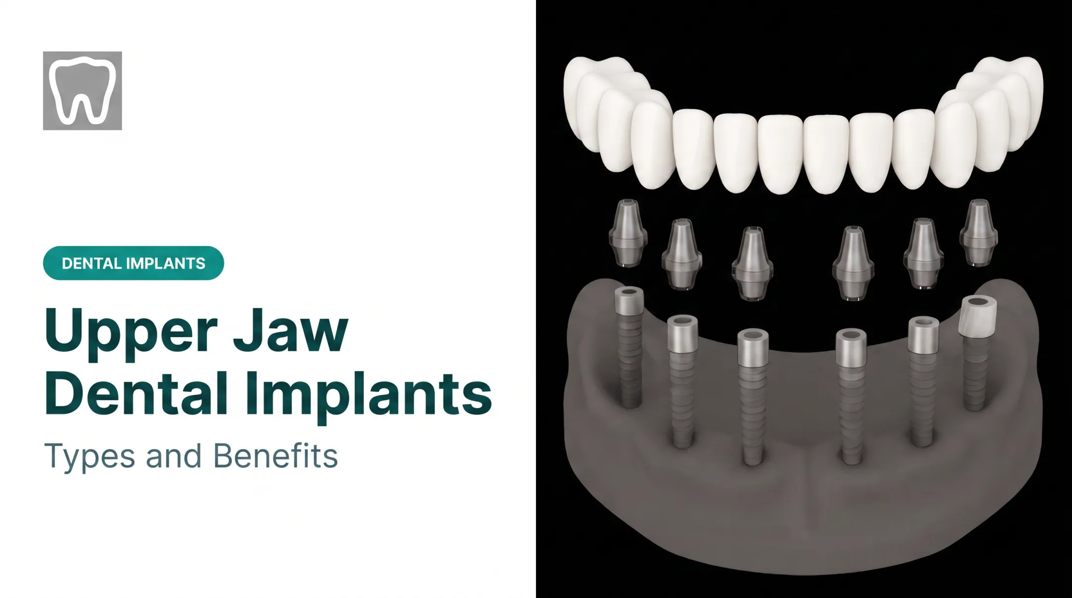 Upper Jaw Dental Implants: Types and Benefits
