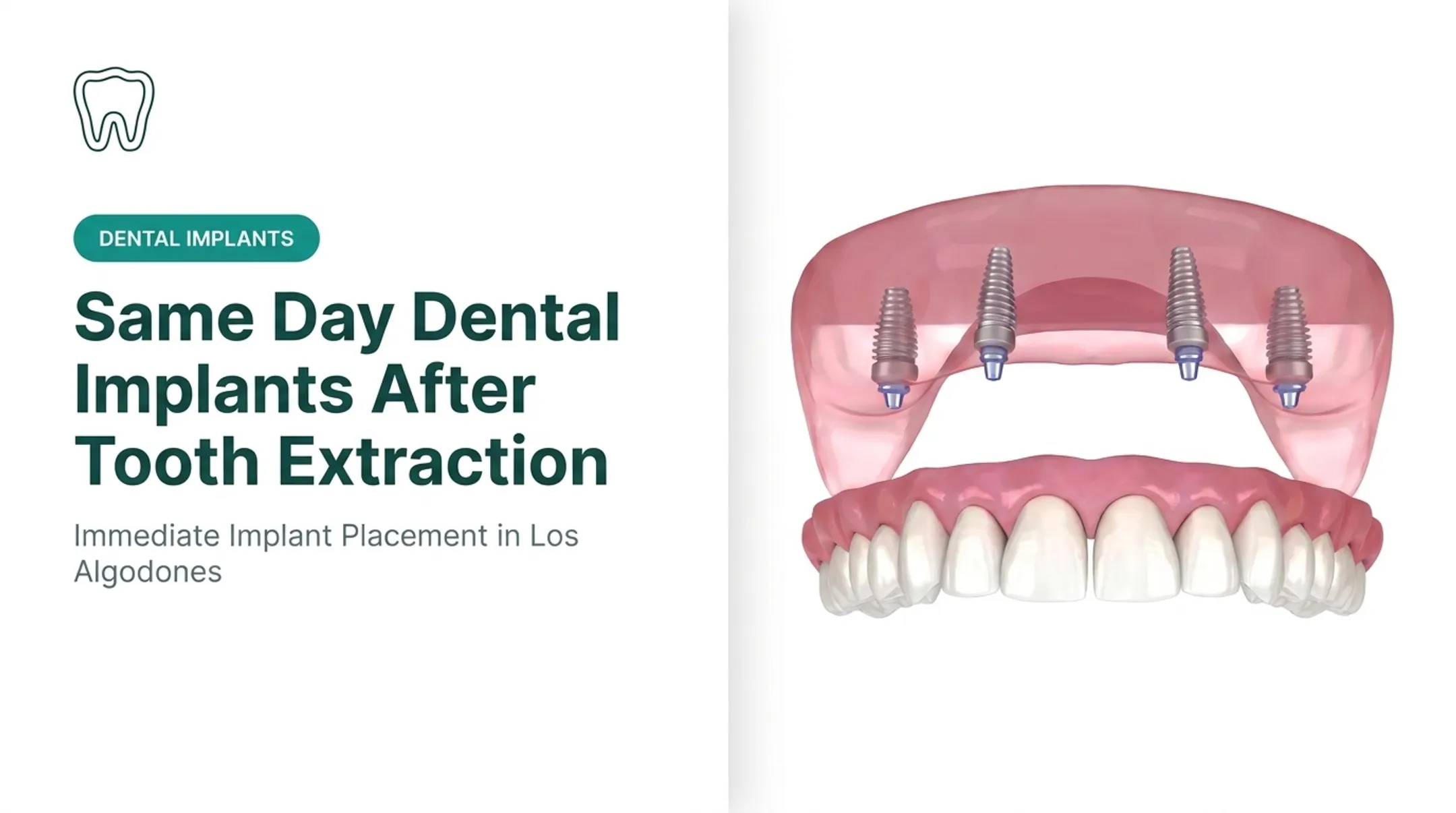 Same Day Dental Implants After Tooth Extraction