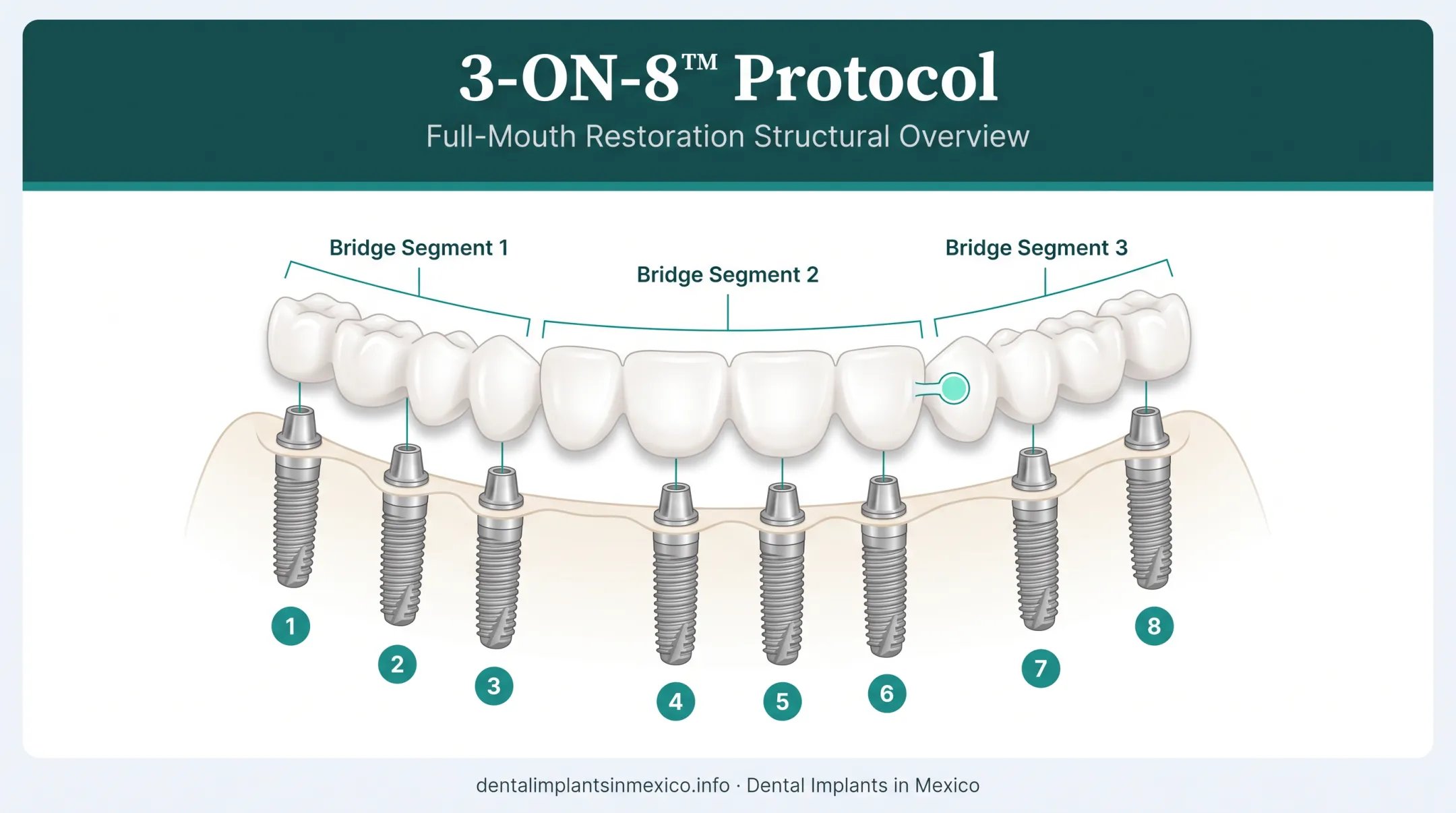 3-ON-8 full arch dental implant protocol structure diagram